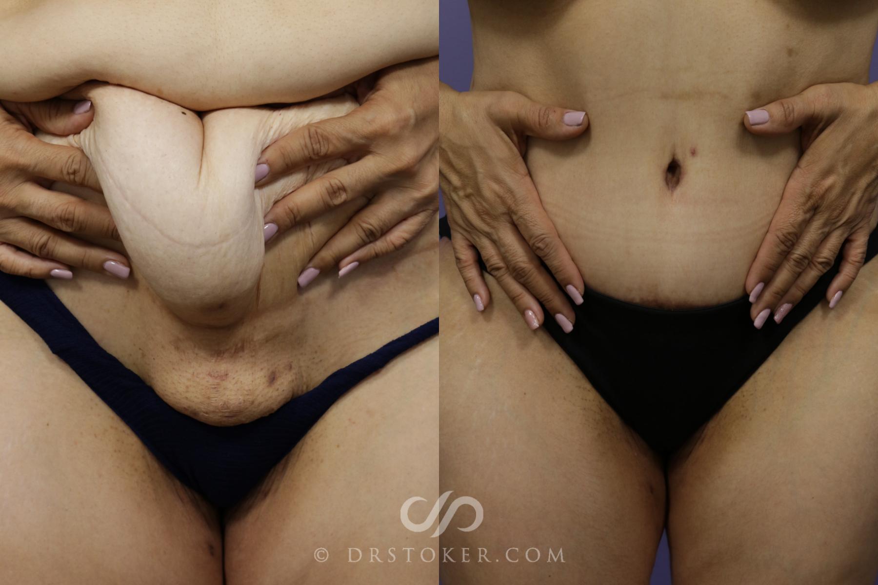 Before & After Tummy Tuck Case 1359 View #7 View in Los Angeles, CA