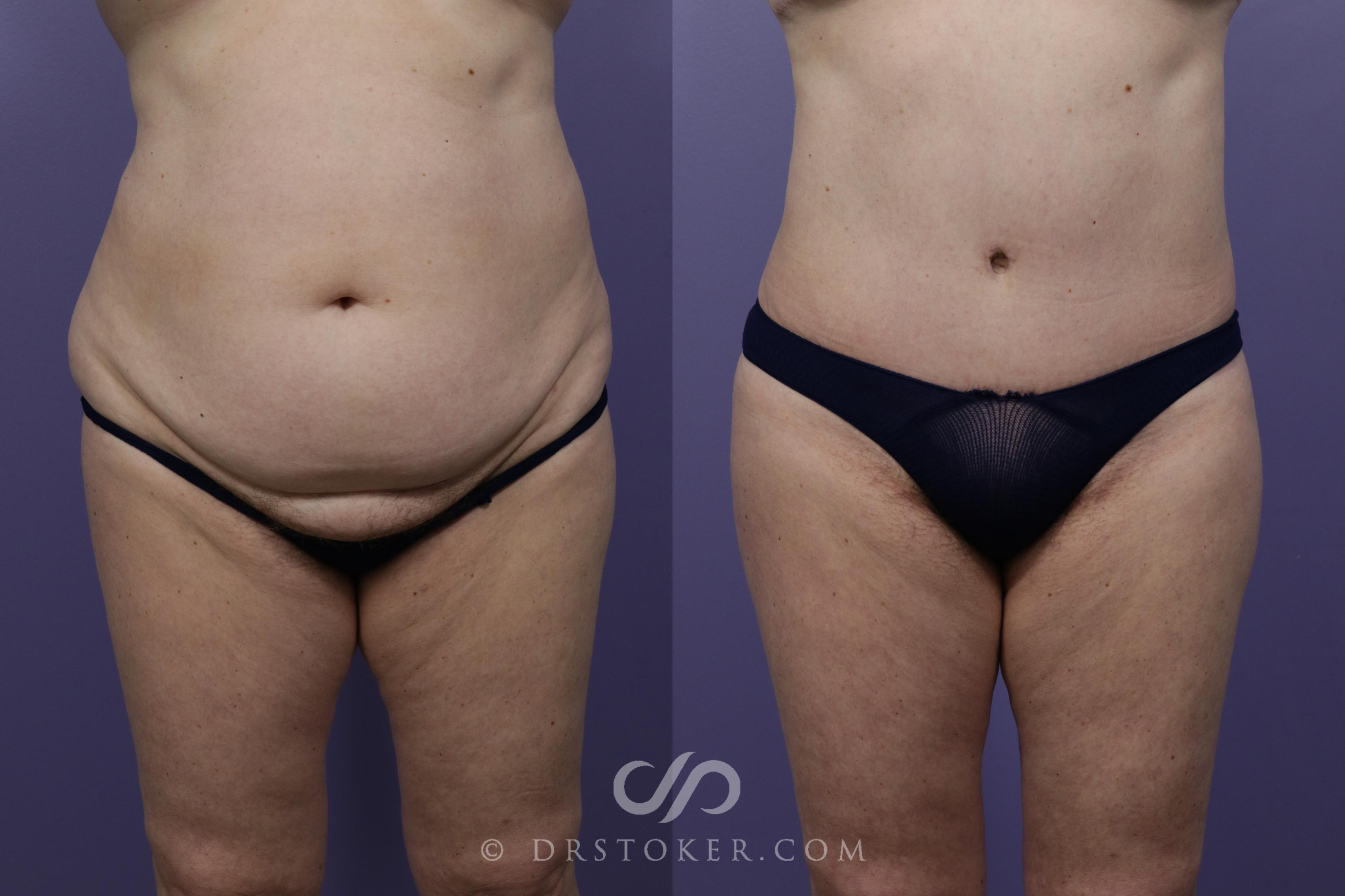 Before & After Tummy Tuck Case 1360 View #1 View in Los Angeles, CA