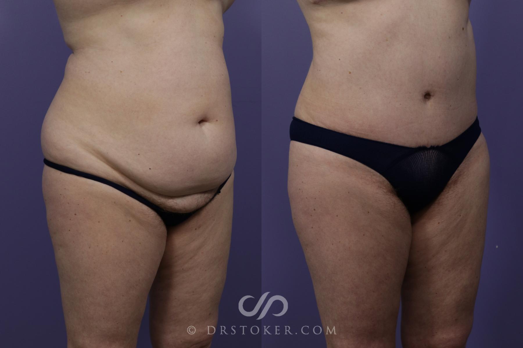 Before & After Tummy Tuck Case 1360 View #2 View in Los Angeles, CA
