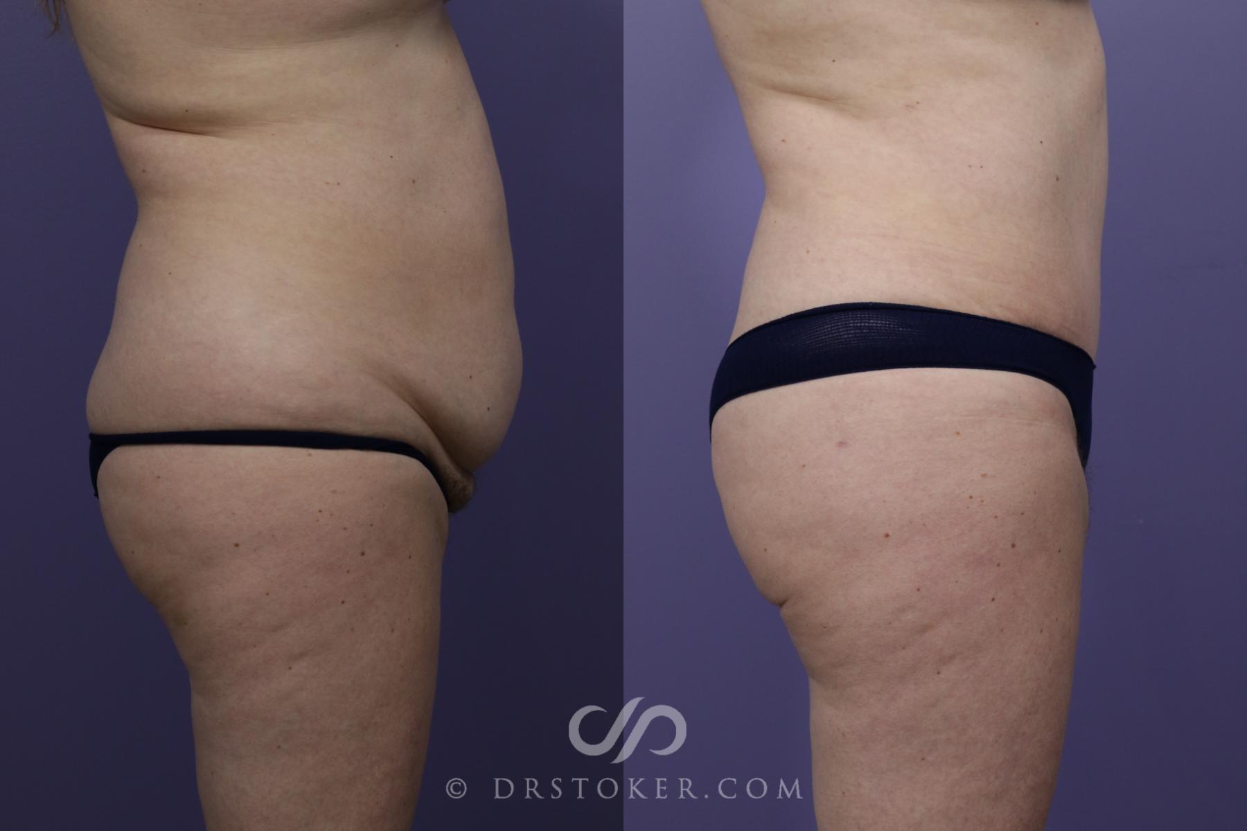 Before & After Tummy Tuck Case 1360 View #3 View in Los Angeles, CA