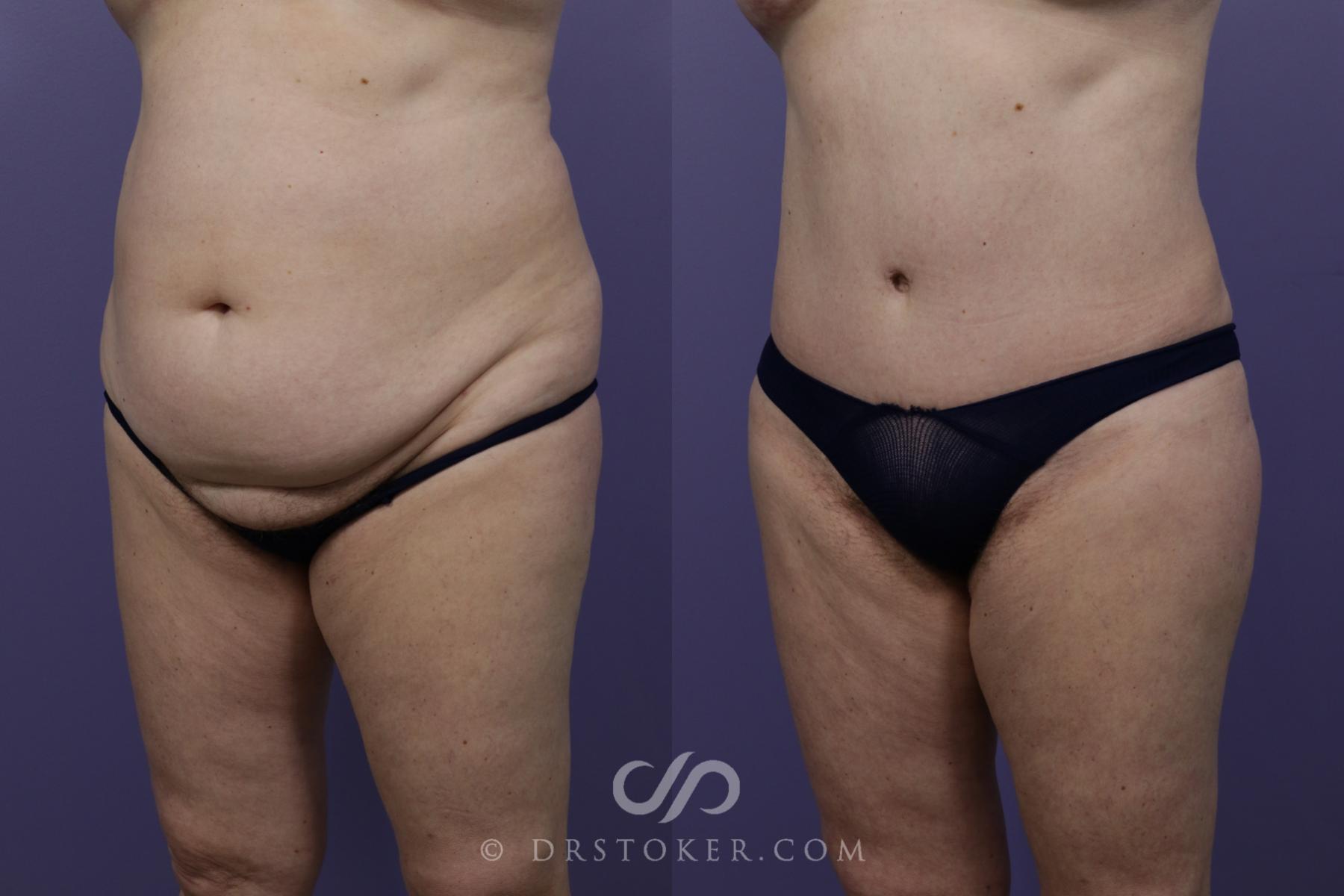 Before & After Tummy Tuck Case 1360 View #4 View in Los Angeles, CA
