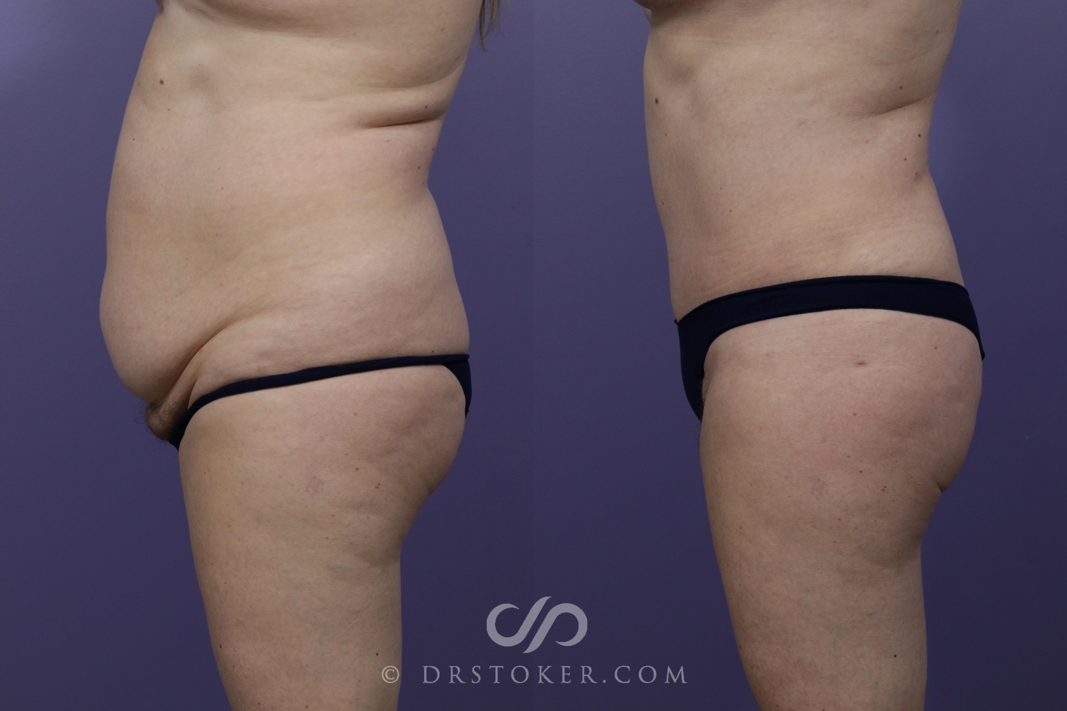 Before & After Tummy Tuck Case 1360 View #5 View in Los Angeles, CA