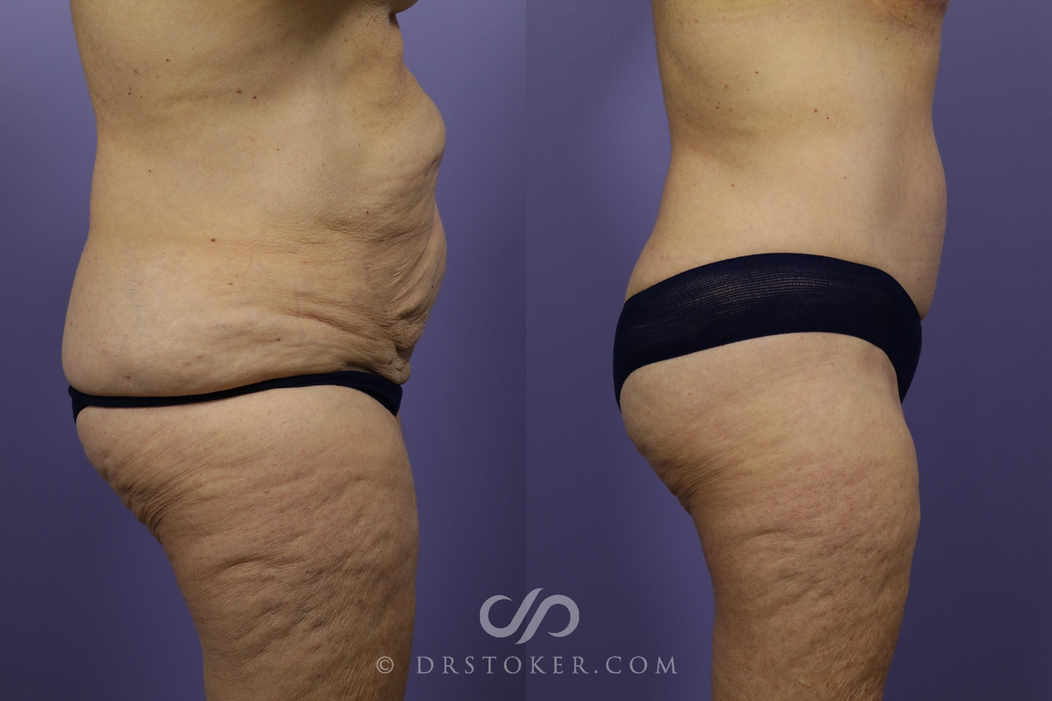 Before & After Tummy Tuck Case 1361 View #1 View in Los Angeles, CA