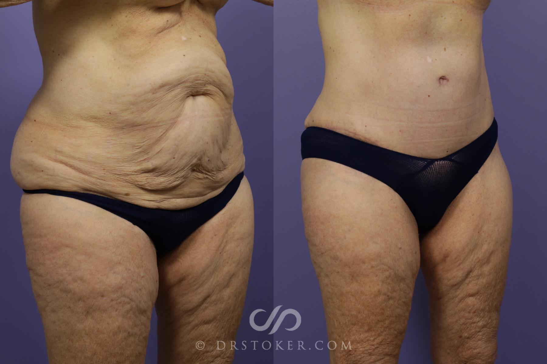 Before & After Tummy Tuck Case 1361 View #2 View in Los Angeles, CA