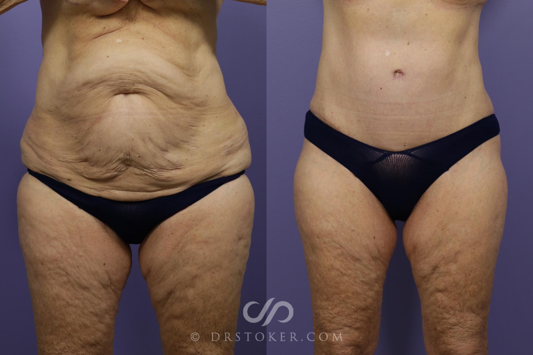Before & After Tummy Tuck Case 1361 View #3 View in Los Angeles, CA