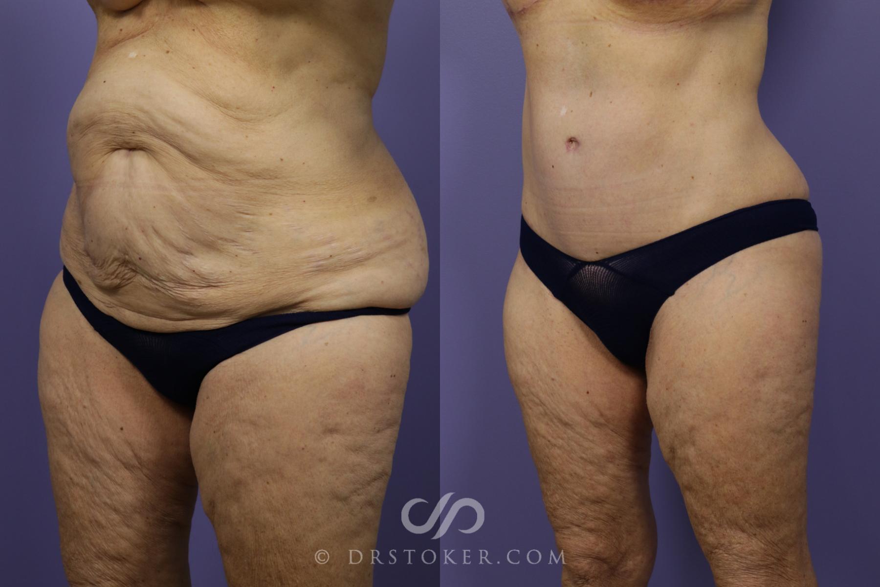 Before & After Tummy Tuck Case 1361 View #4 View in Los Angeles, CA