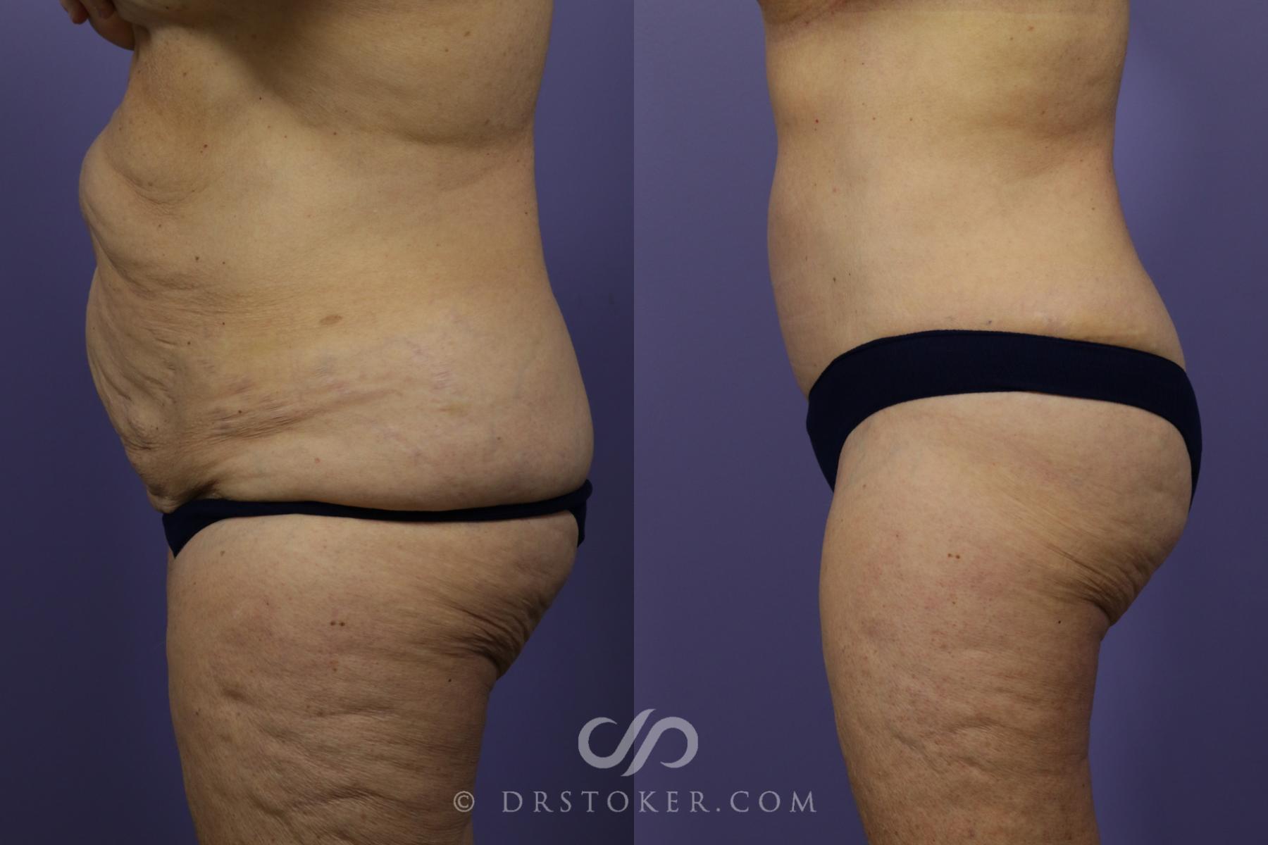 Before & After Tummy Tuck Case 1361 View #5 View in Los Angeles, CA