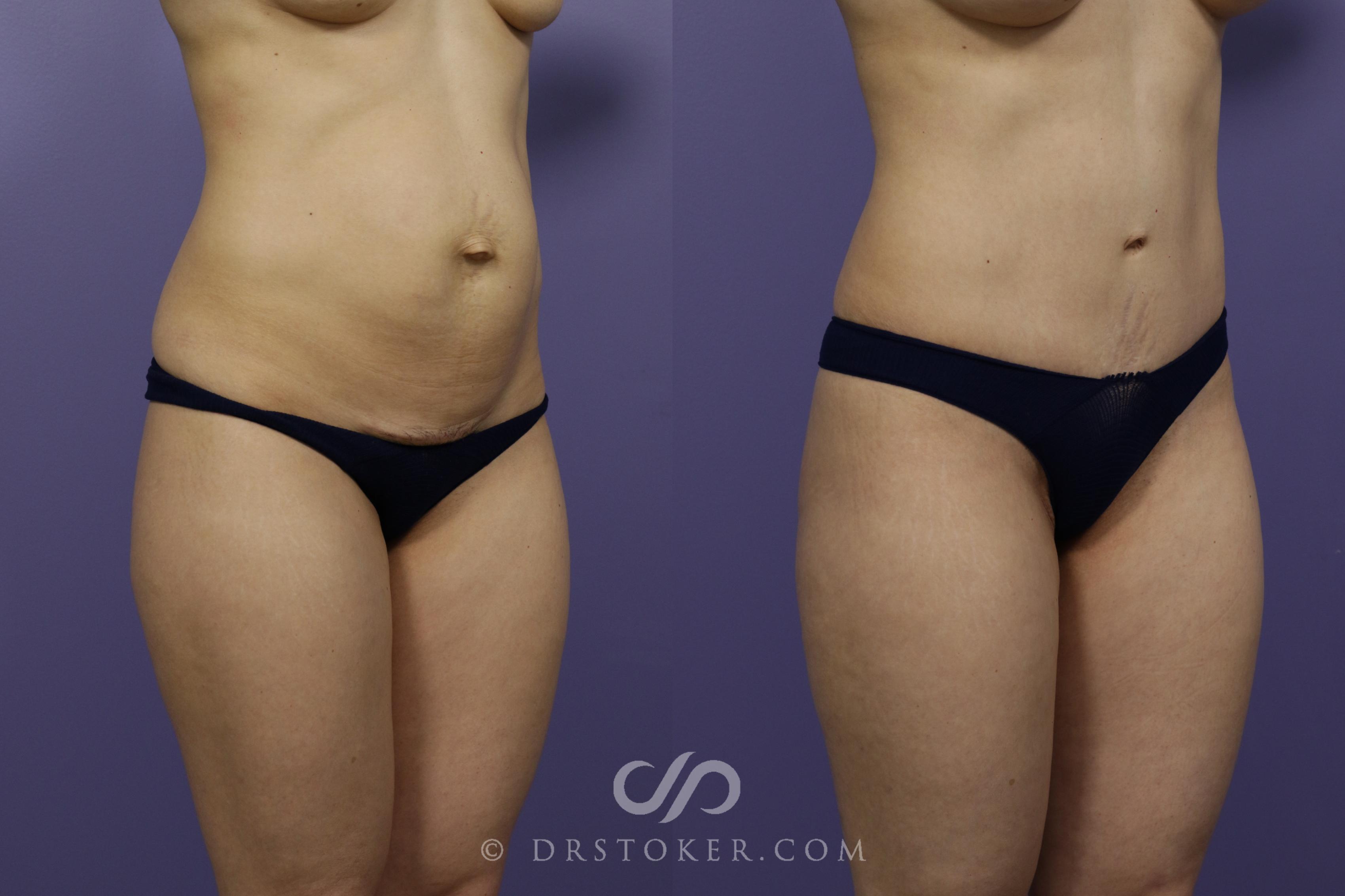 Before & After Tummy Tuck Case 1363 View #1 View in Los Angeles, CA