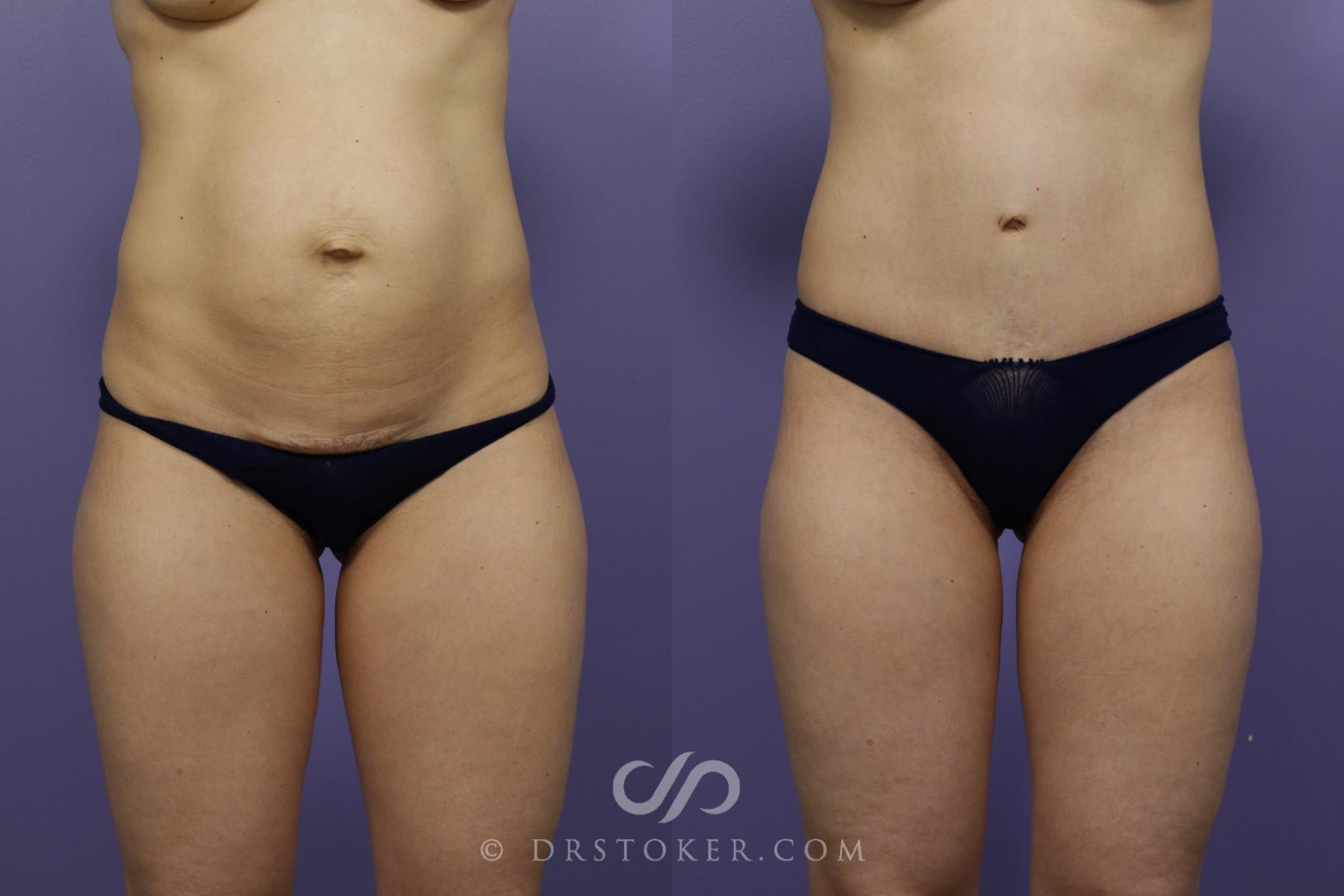 Before & After Tummy Tuck Case 1363 View #2 View in Los Angeles, CA