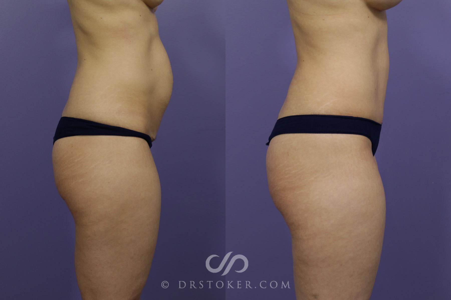 Before & After Tummy Tuck Case 1363 View #3 View in Los Angeles, CA