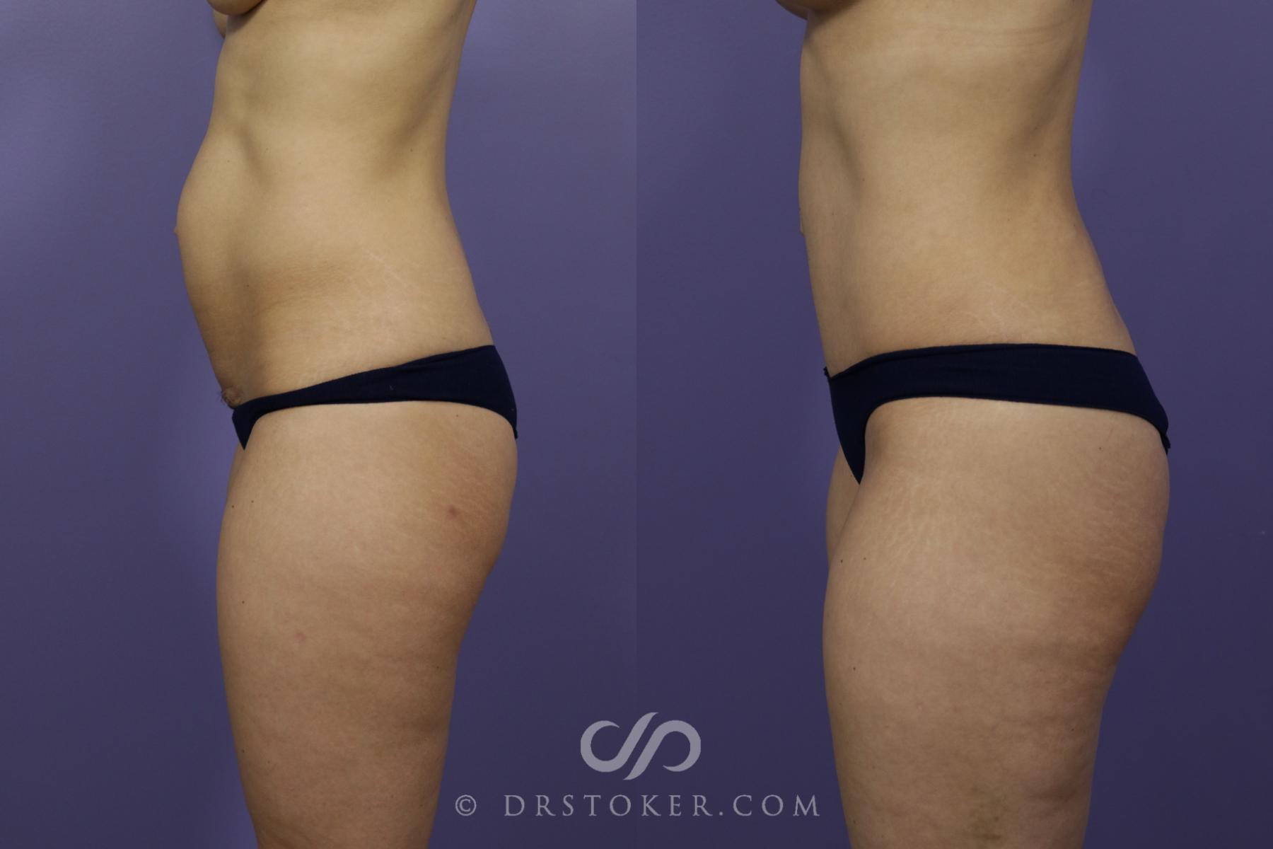 Before & After Tummy Tuck Case 1363 View #4 View in Los Angeles, CA