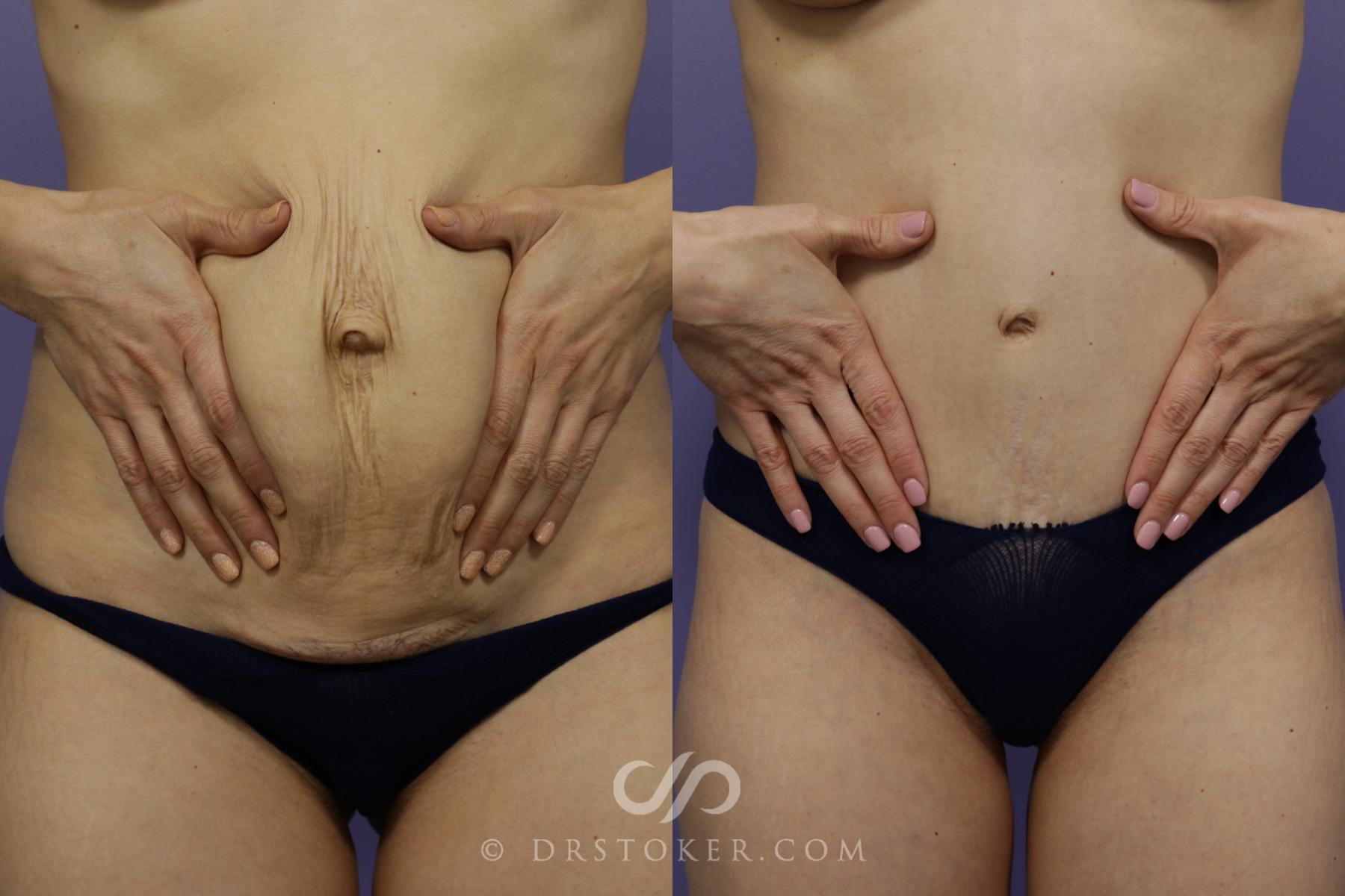 Before & After Tummy Tuck Case 1363 View #5 View in Los Angeles, CA