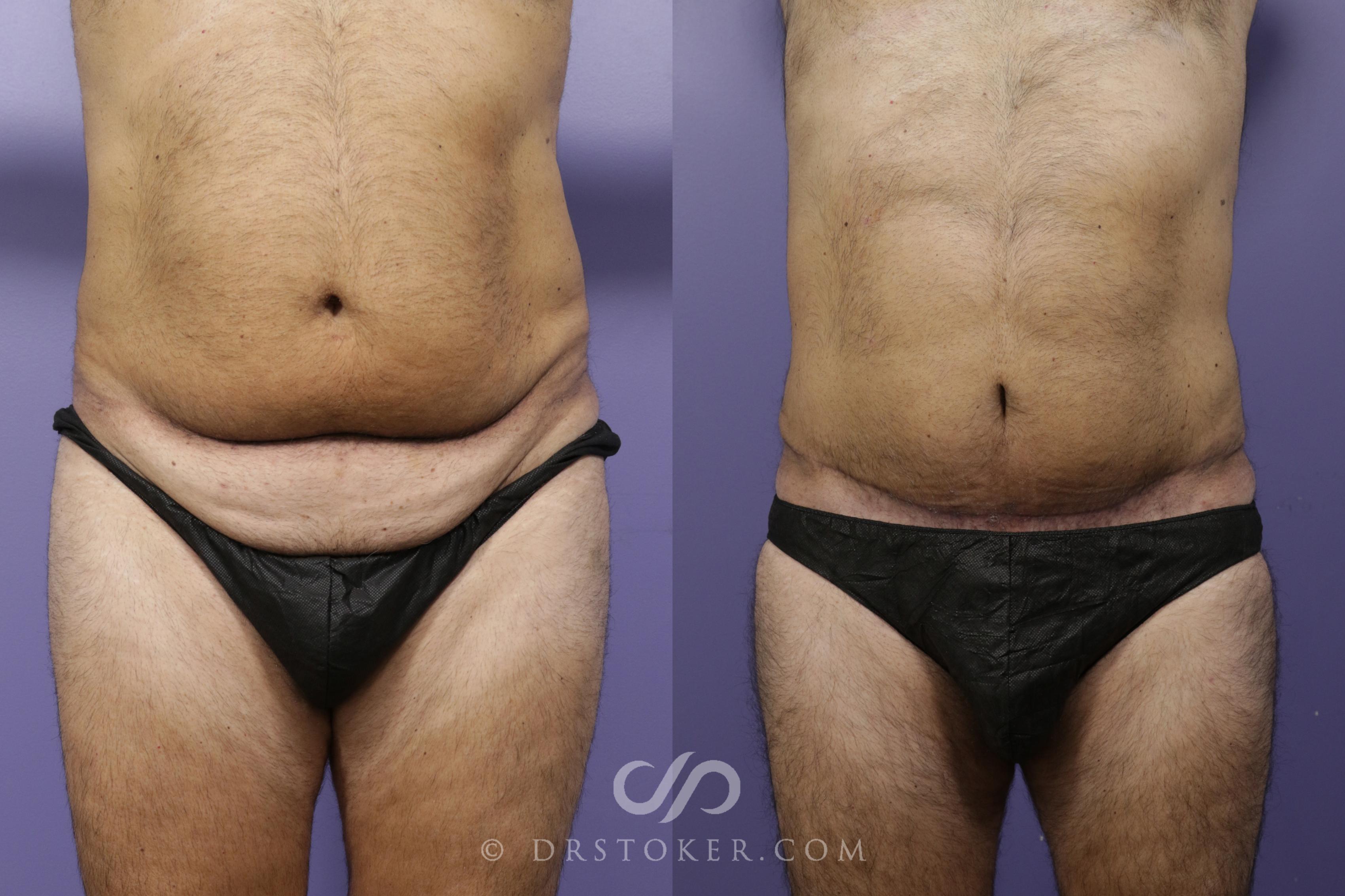 Before & After Tummy Tuck Case 1364 View #1 View in Los Angeles, CA
