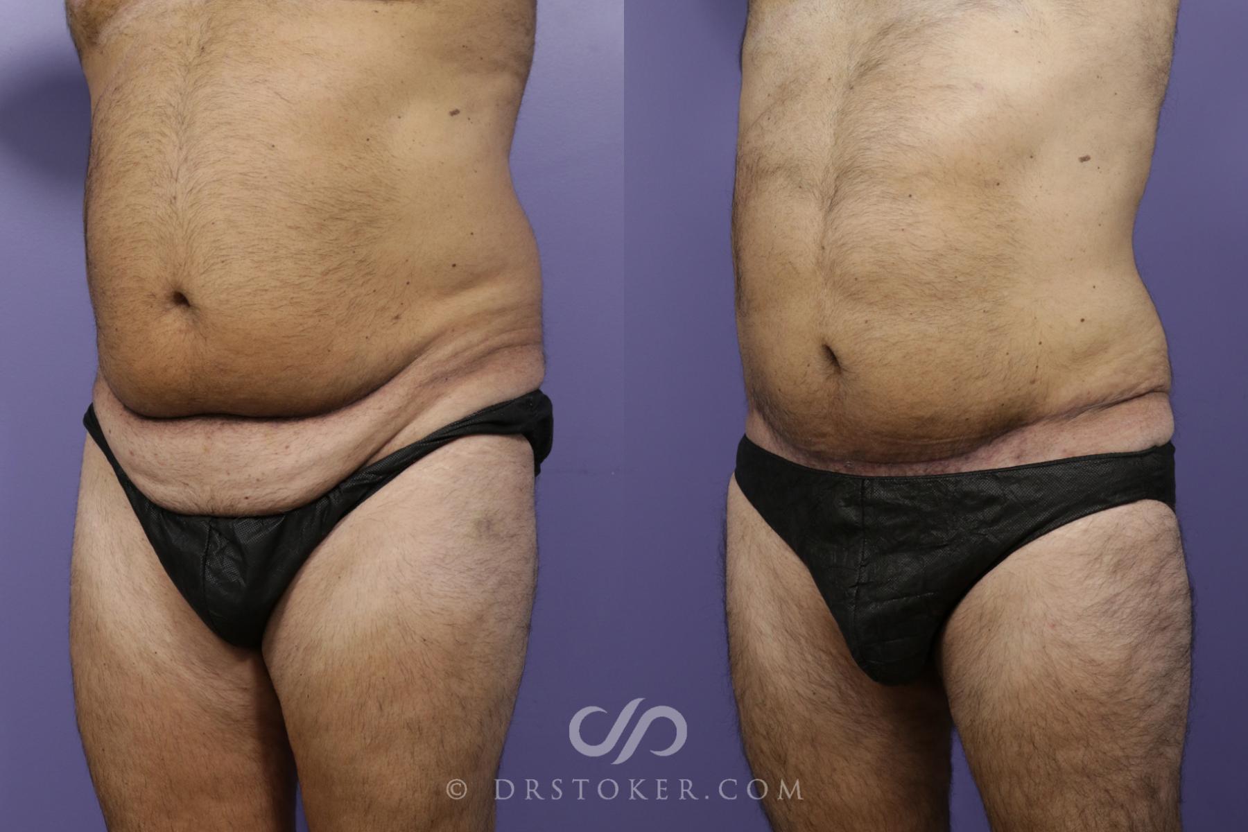 Before & After Tummy Tuck Case 1364 View #2 View in Los Angeles, CA
