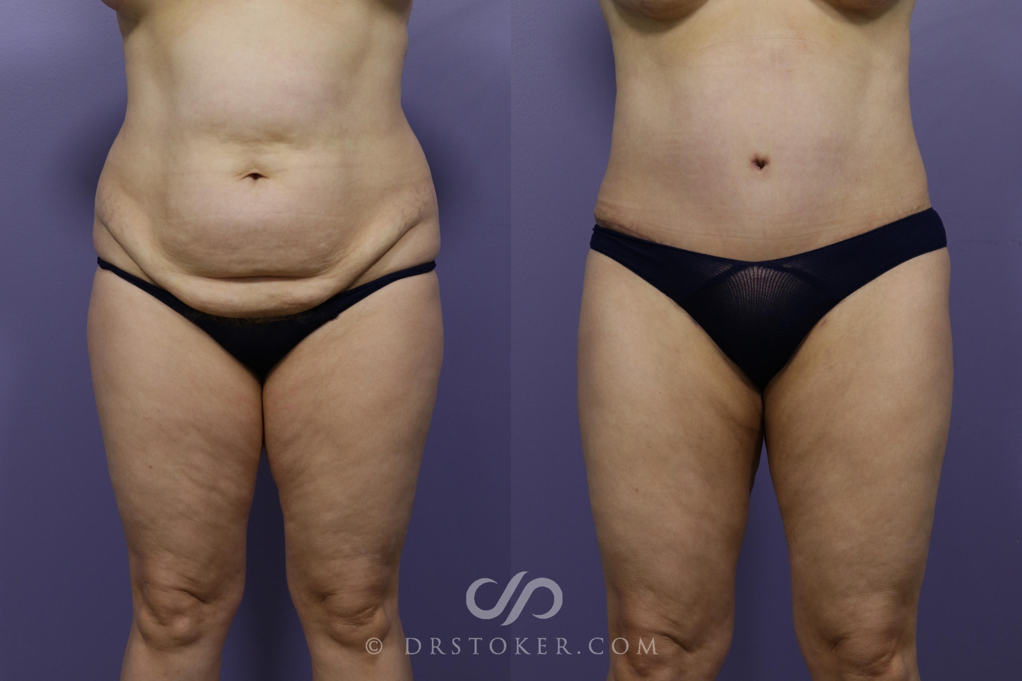 Before & After Tummy Tuck Case 1365 View #1 View in Los Angeles, CA