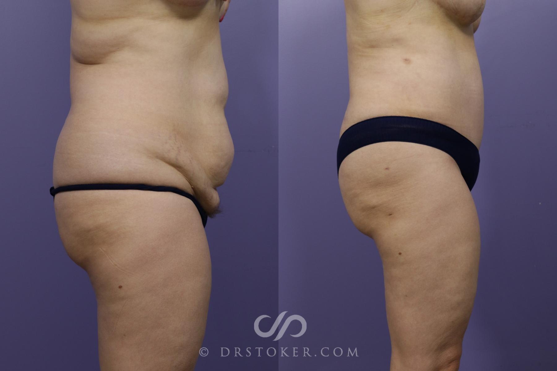 Before & After Tummy Tuck Case 1365 View #2 View in Los Angeles, CA