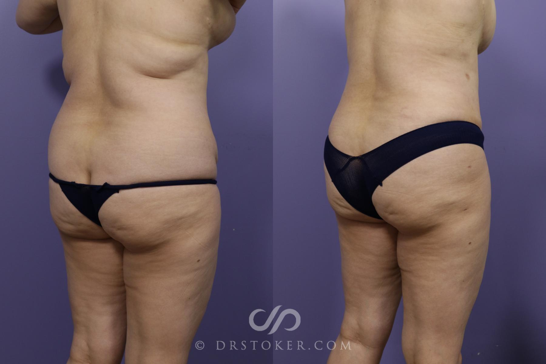 Before & After Tummy Tuck Case 1365 View #3 View in Los Angeles, CA