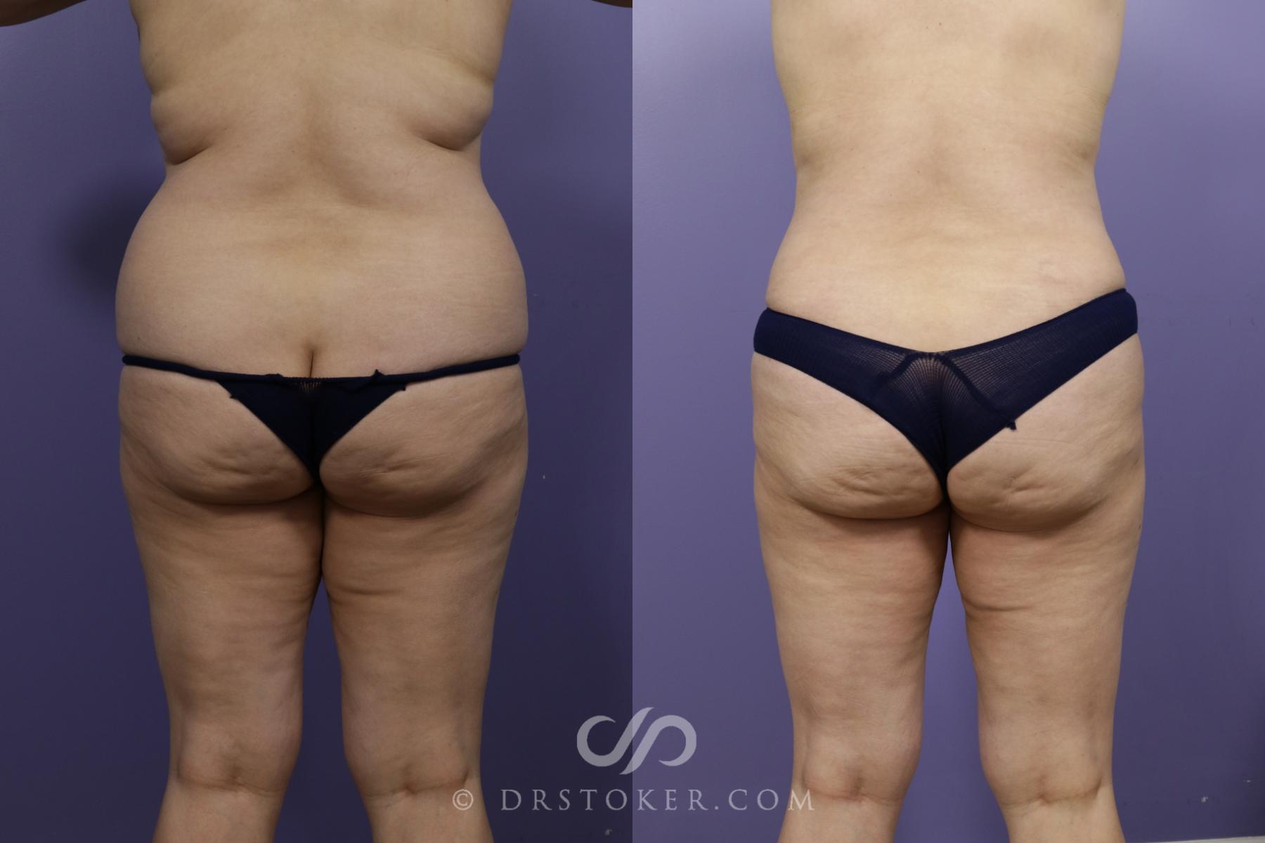 Before & After Tummy Tuck Case 1365 View #4 View in Los Angeles, CA