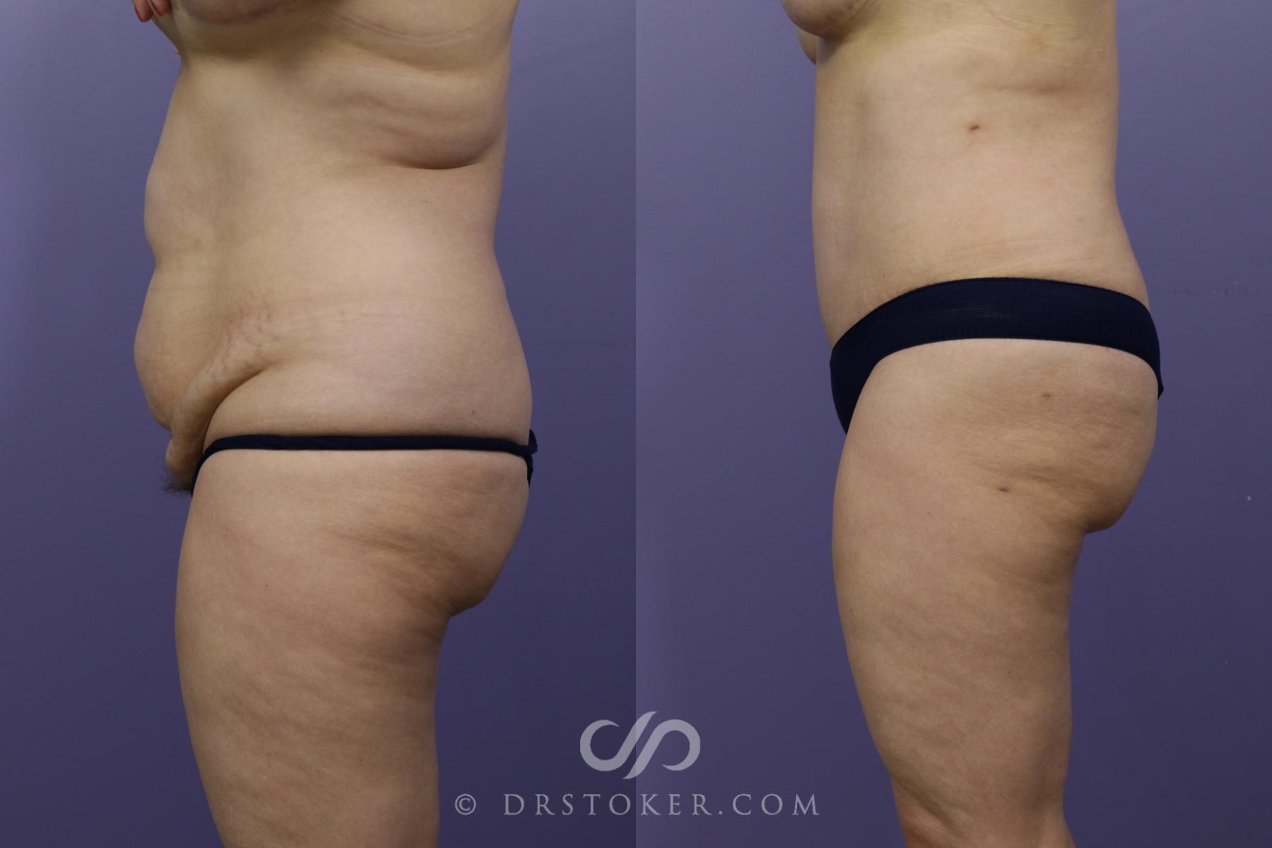 Before & After Tummy Tuck Case 1365 View #5 View in Los Angeles, CA