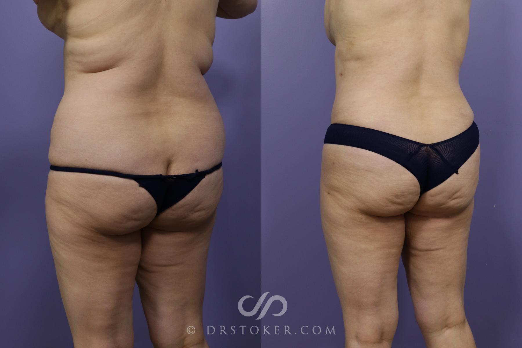 Before & After Tummy Tuck Case 1365 View #6 View in Los Angeles, CA