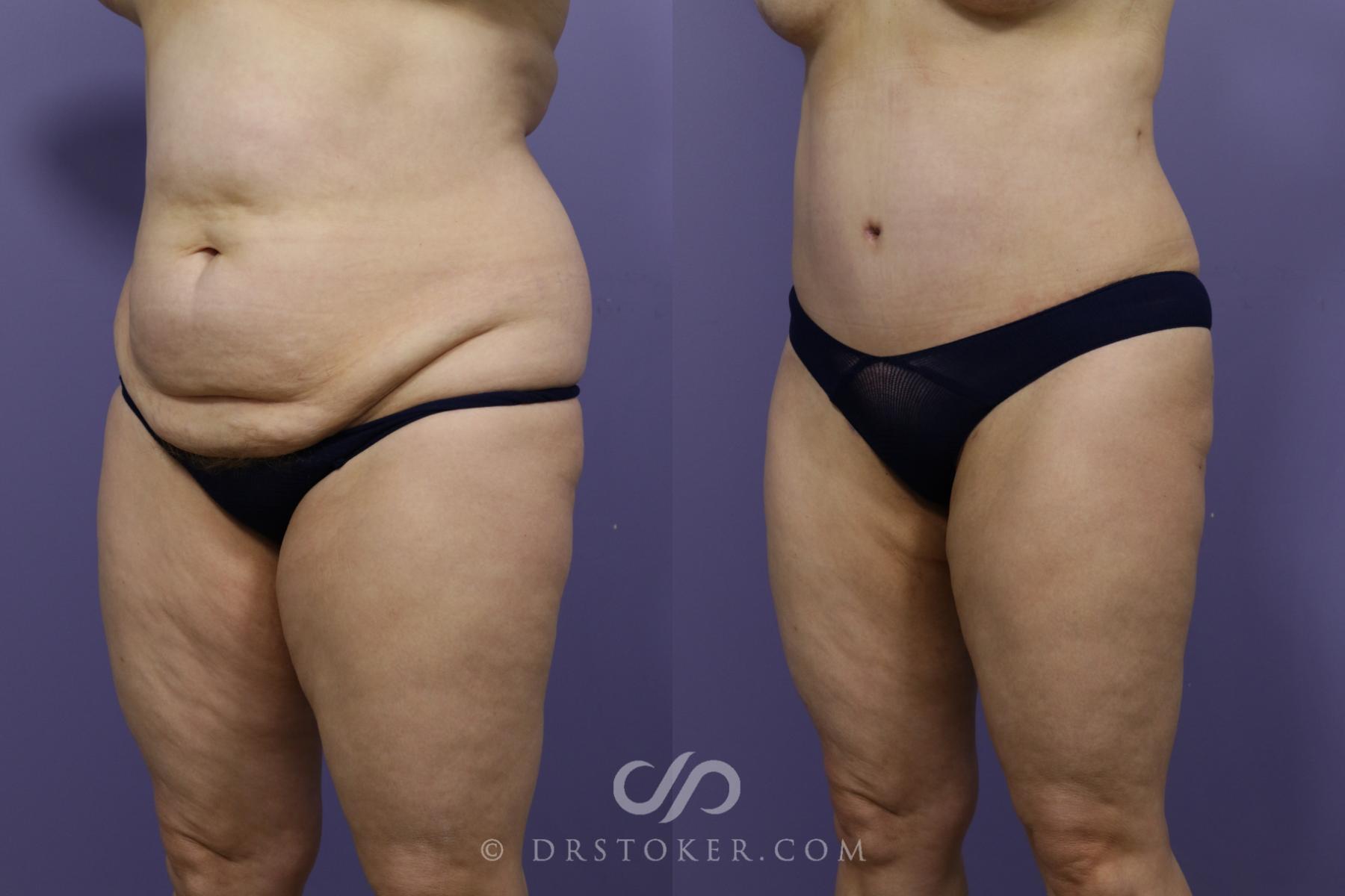 Before & After Tummy Tuck Case 1365 View #7 View in Los Angeles, CA