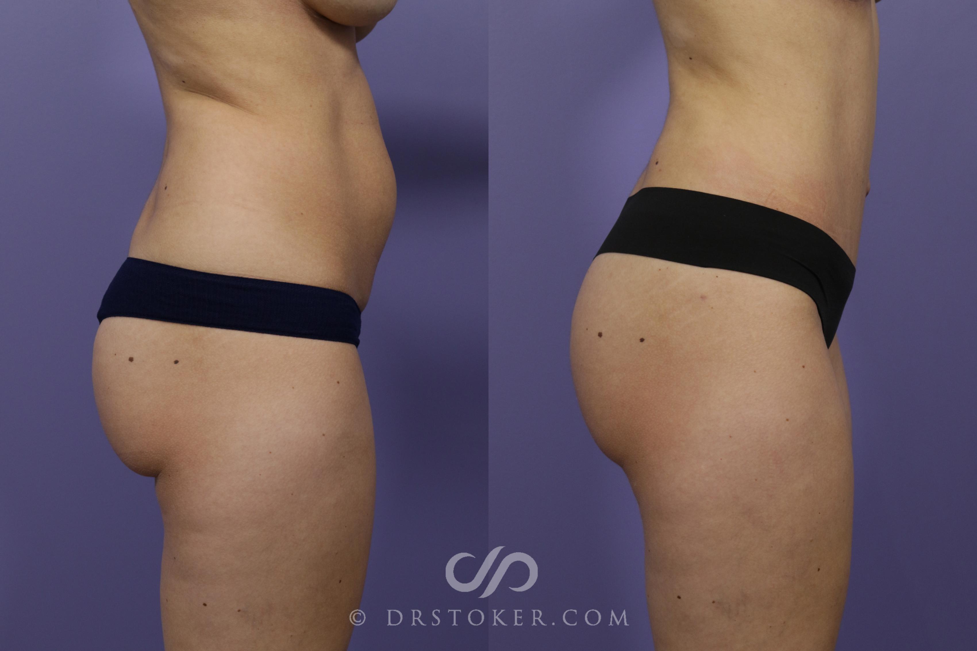 Before & After Tummy Tuck Case 1371 View #1 View in Los Angeles, CA