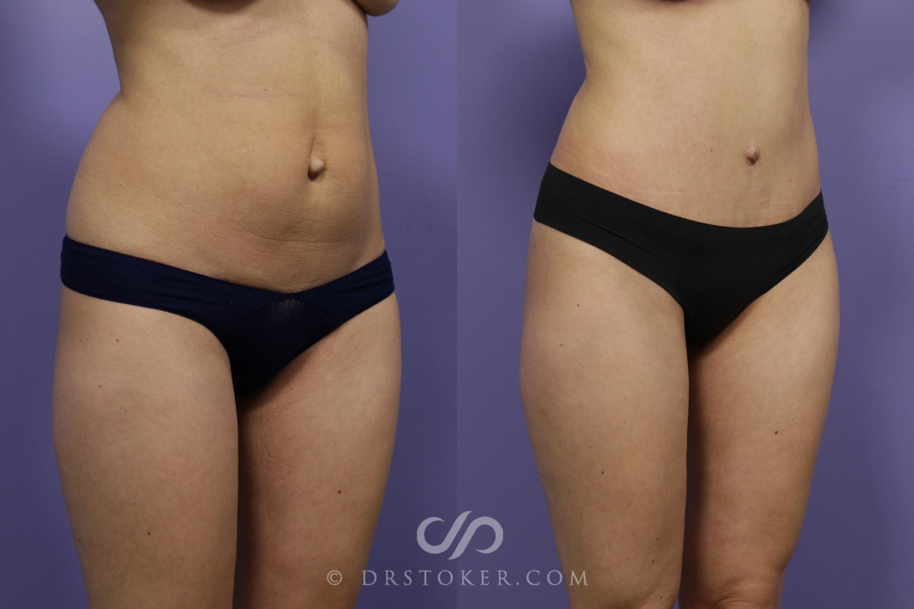 Before & After Tummy Tuck Case 1371 View #2 View in Los Angeles, CA