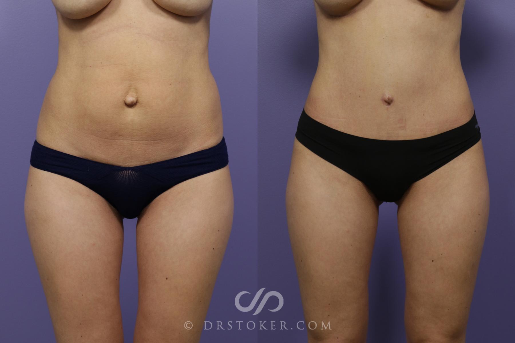 Before & After Tummy Tuck Case 1371 View #3 View in Los Angeles, CA