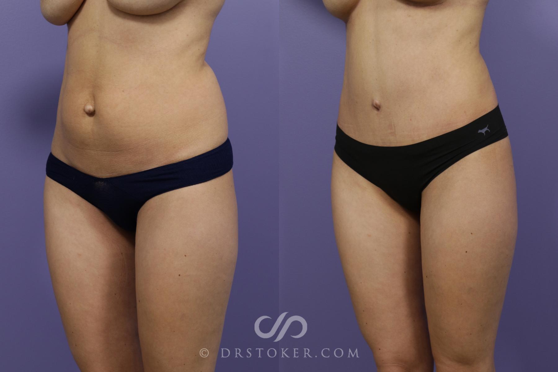 Before & After Tummy Tuck Case 1371 View #4 View in Los Angeles, CA