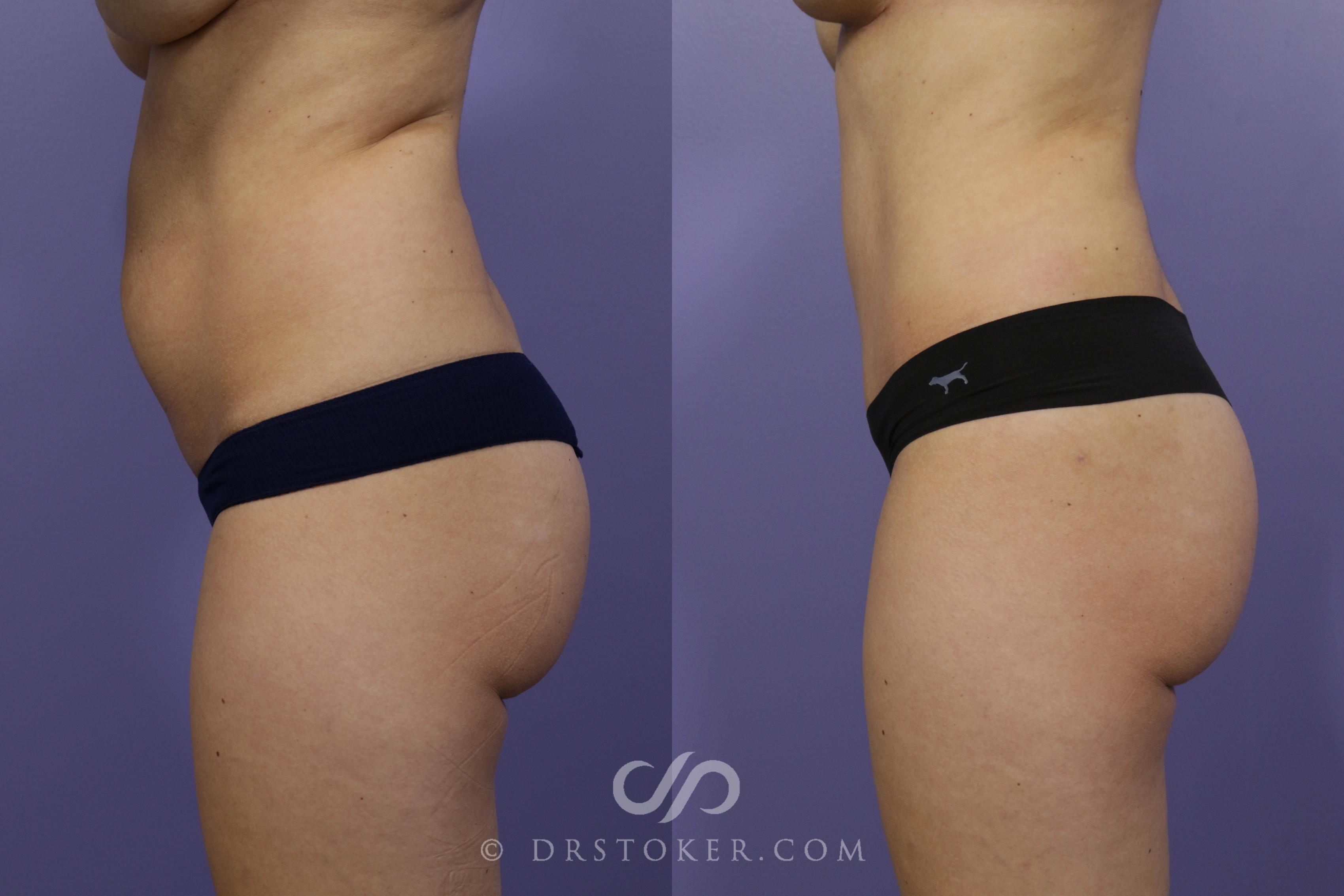 Before & After Tummy Tuck Case 1371 View #5 View in Los Angeles, CA