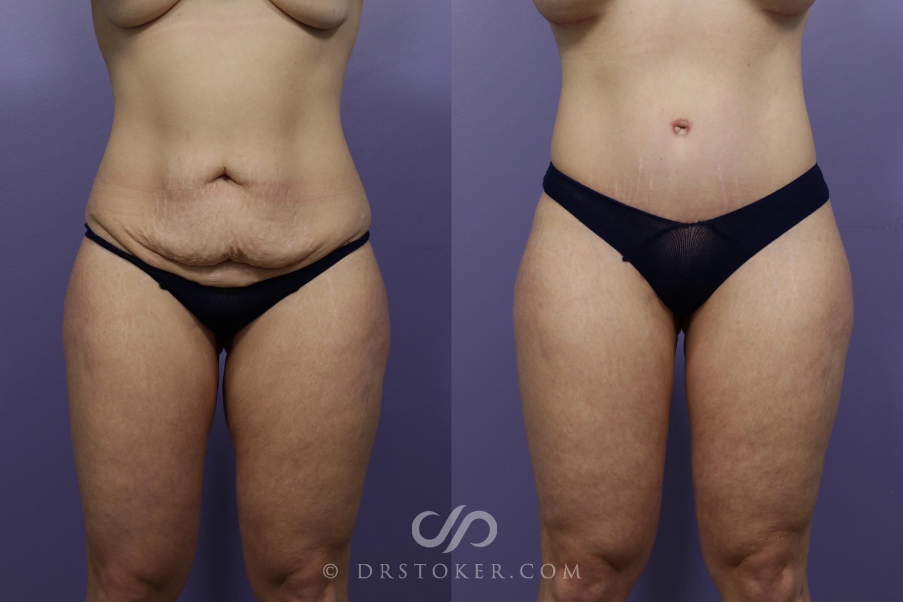 Before & After Tummy Tuck Case 1372 View #1 View in Los Angeles, CA
