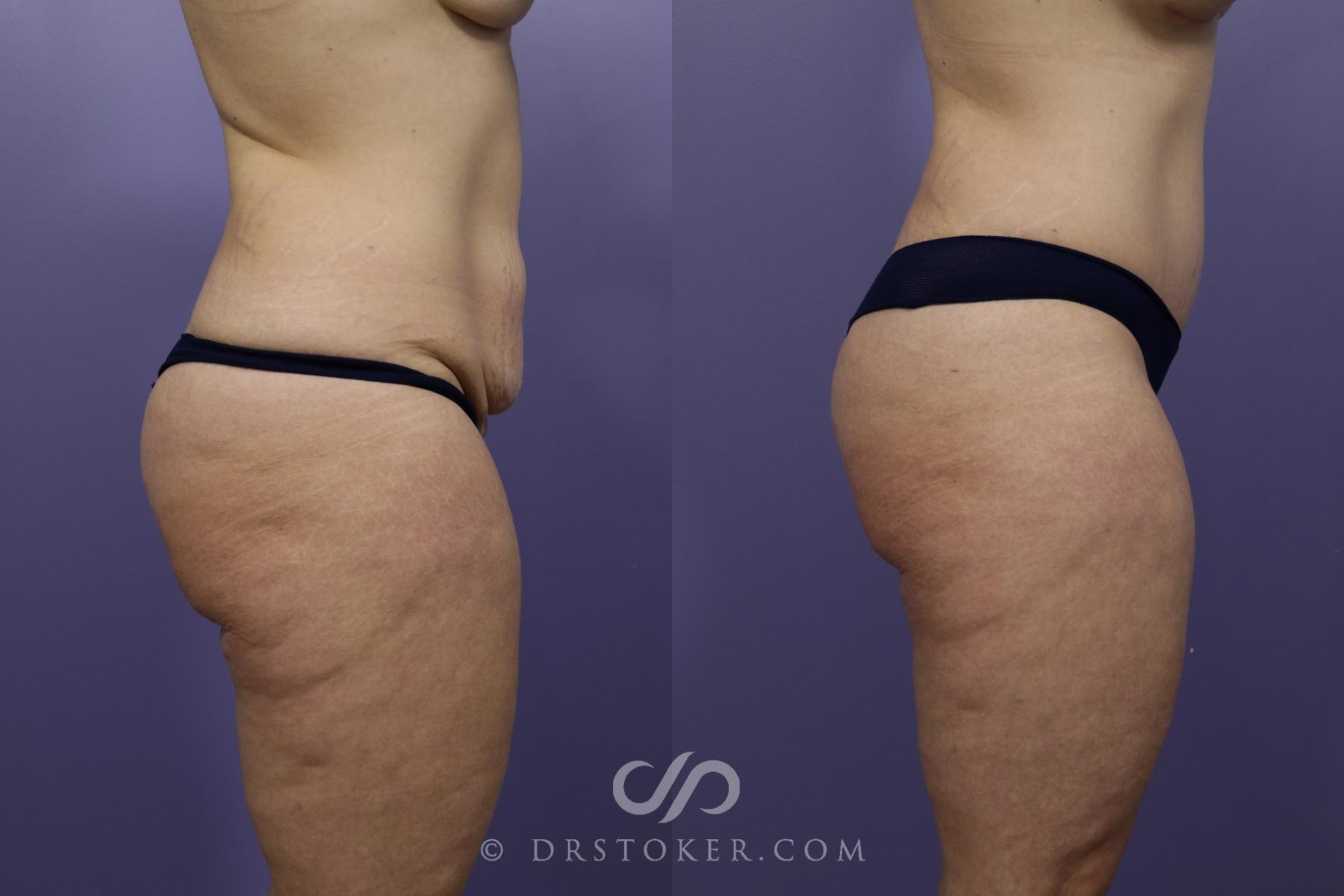 Before & After Tummy Tuck Case 1372 View #3 View in Los Angeles, CA