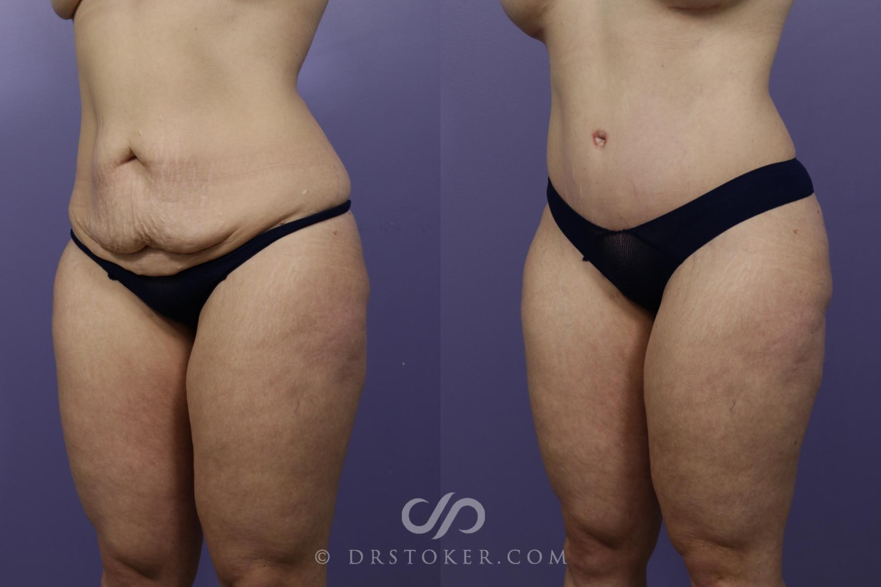 Before & After Tummy Tuck Case 1372 View #4 View in Los Angeles, CA