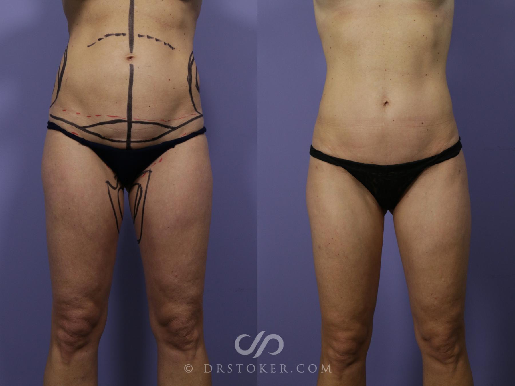 Before & After Tummy Tuck Case 1455 View #2 View in Los Angeles, CA