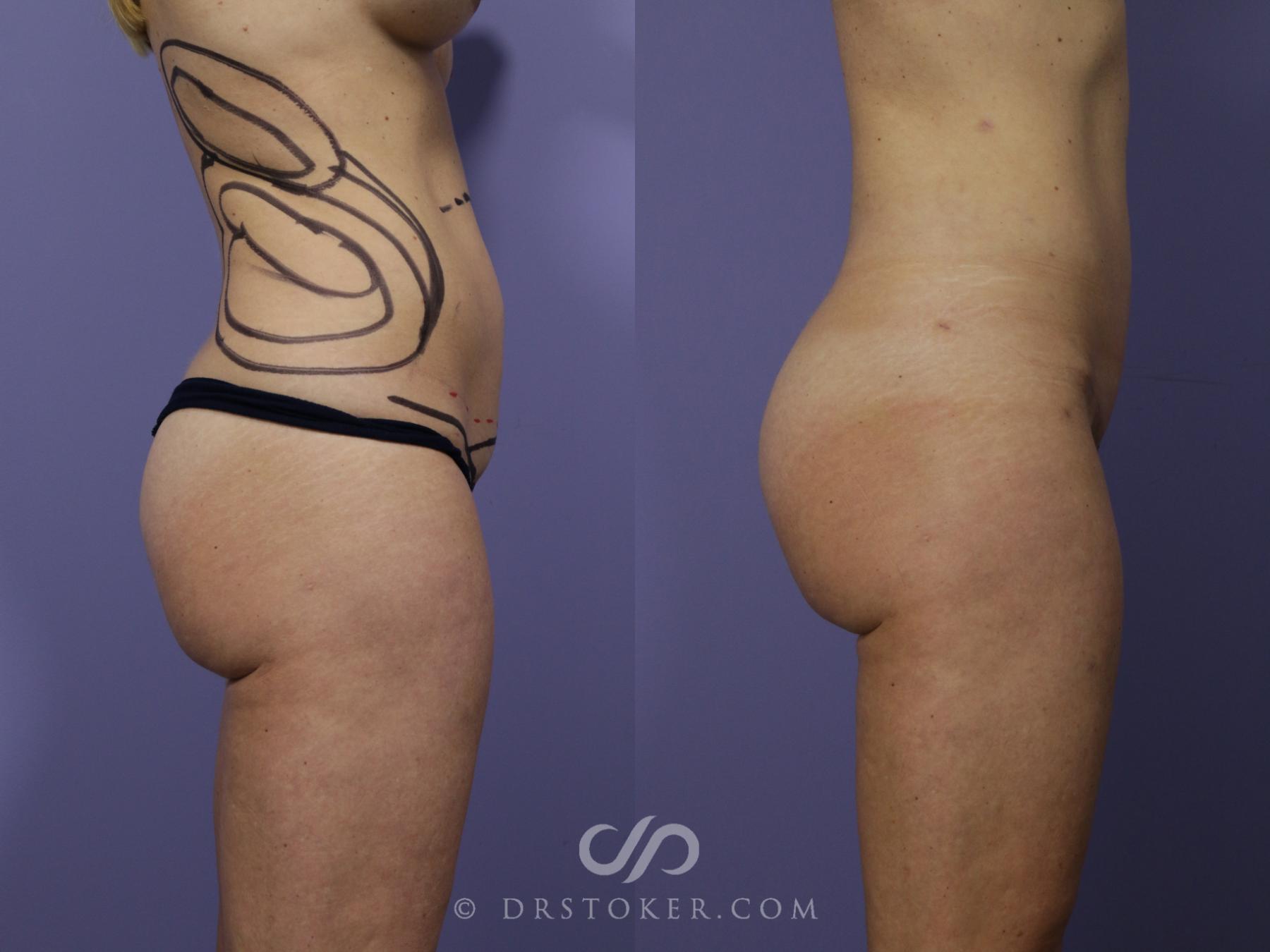 Before & After Tummy Tuck Case 1455 View #3 View in Los Angeles, CA