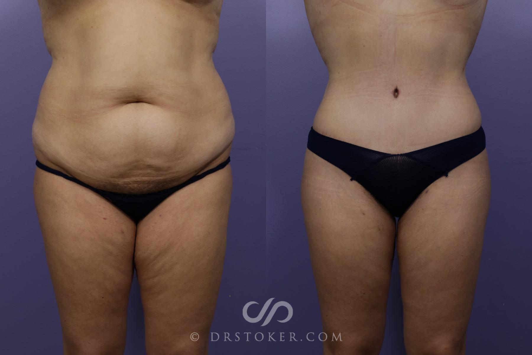 Before & After Tummy Tuck Case 1465 View #1 View in Los Angeles, CA