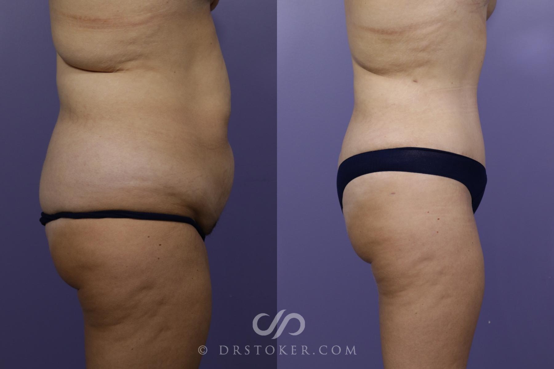 Before & After Tummy Tuck Case 1465 View #2 View in Los Angeles, CA