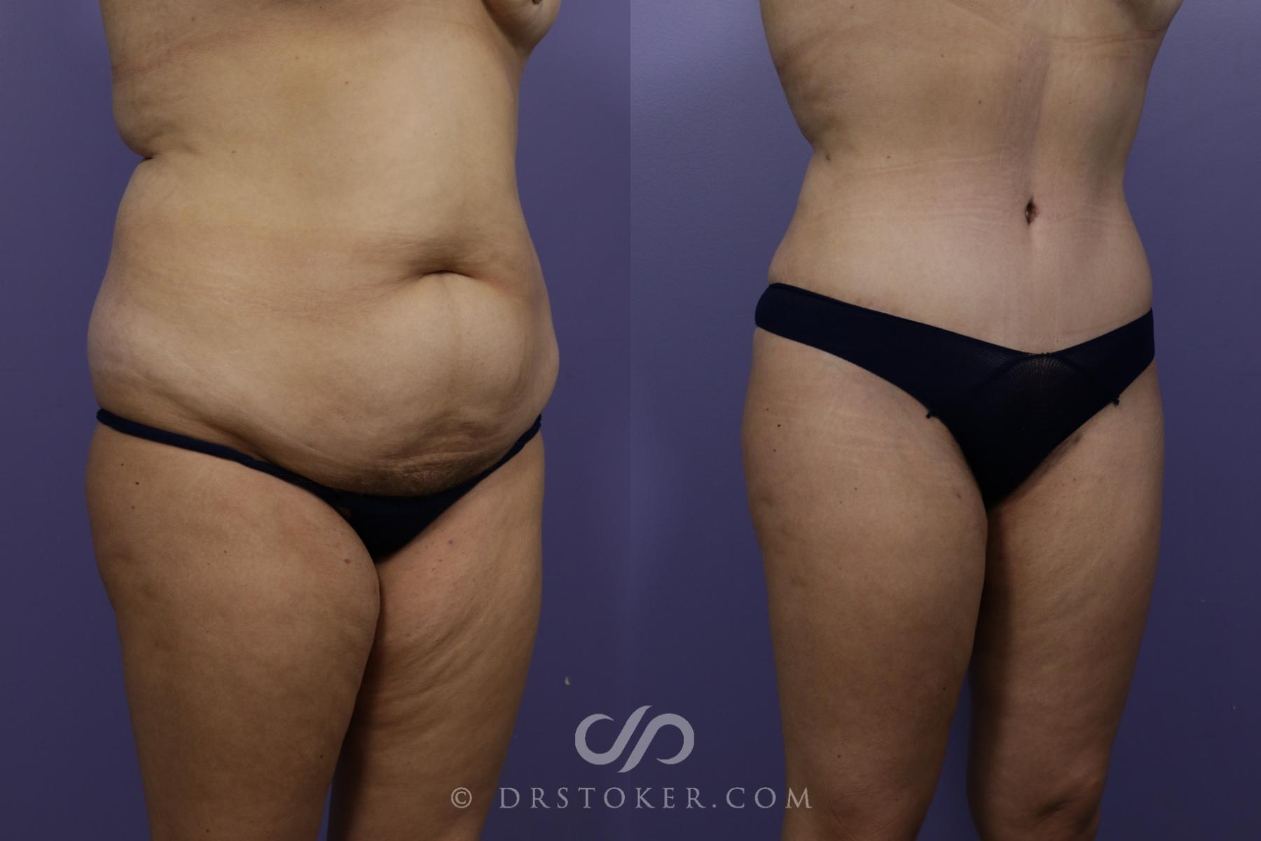 Before & After Tummy Tuck Case 1465 View #3 View in Los Angeles, CA