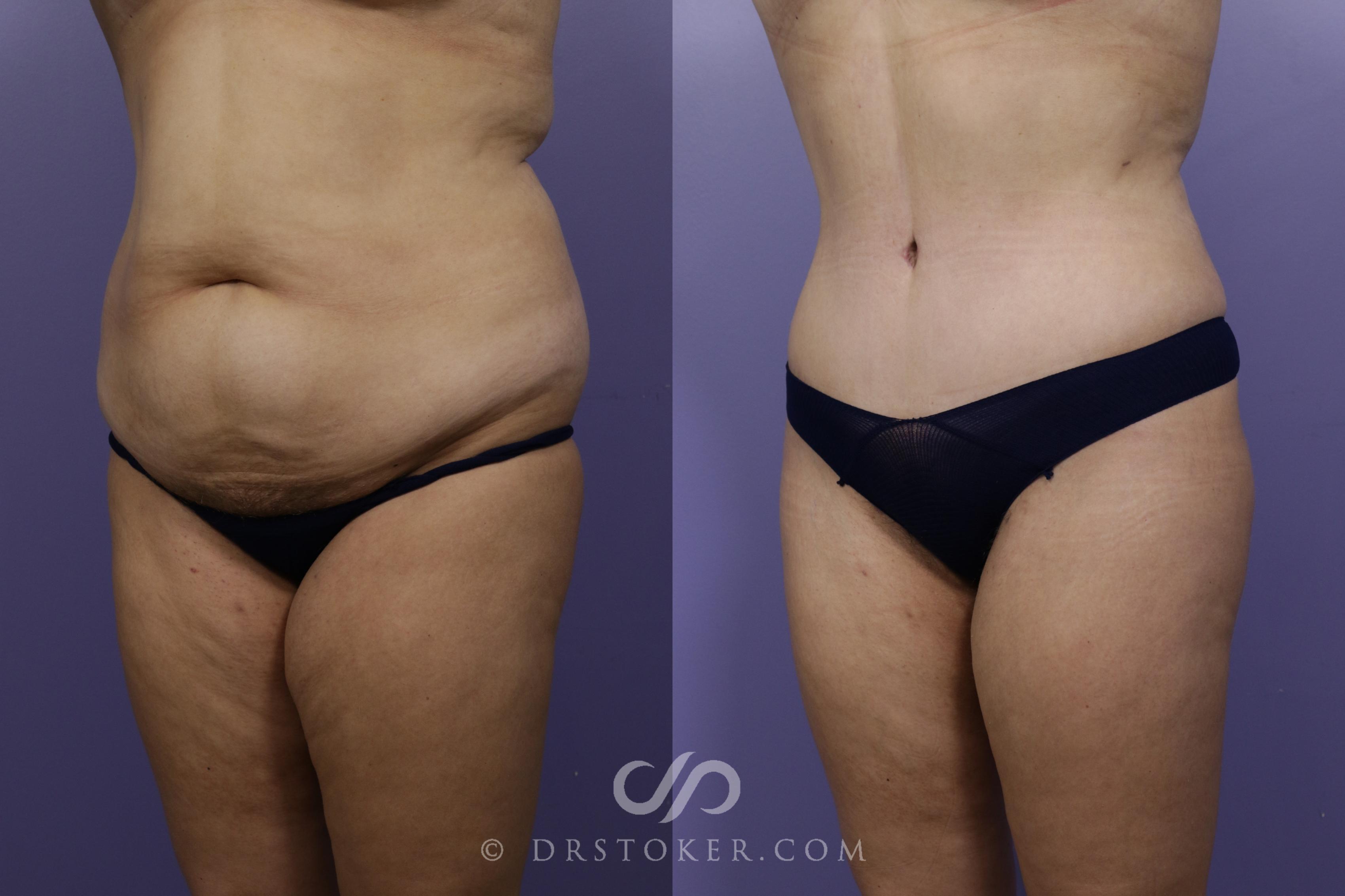 Before & After Tummy Tuck Case 1465 View #4 View in Los Angeles, CA