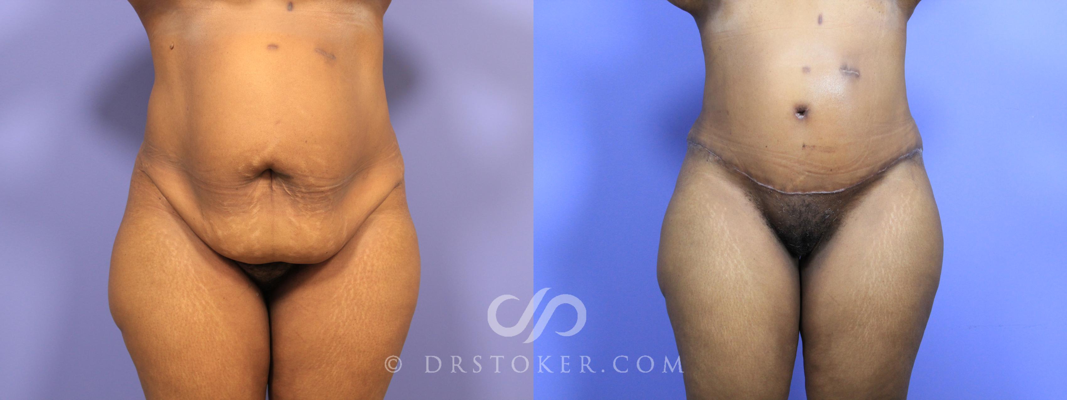 Before & After Tummy Tuck Case 1466 View #1 View in Los Angeles, CA