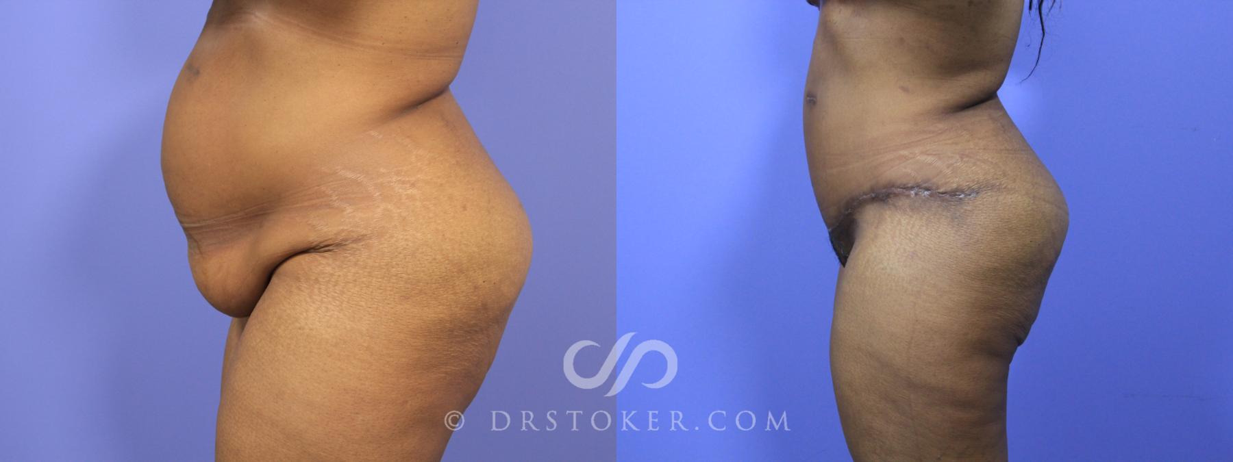 Before & After Tummy Tuck Case 1466 View #2 View in Los Angeles, CA
