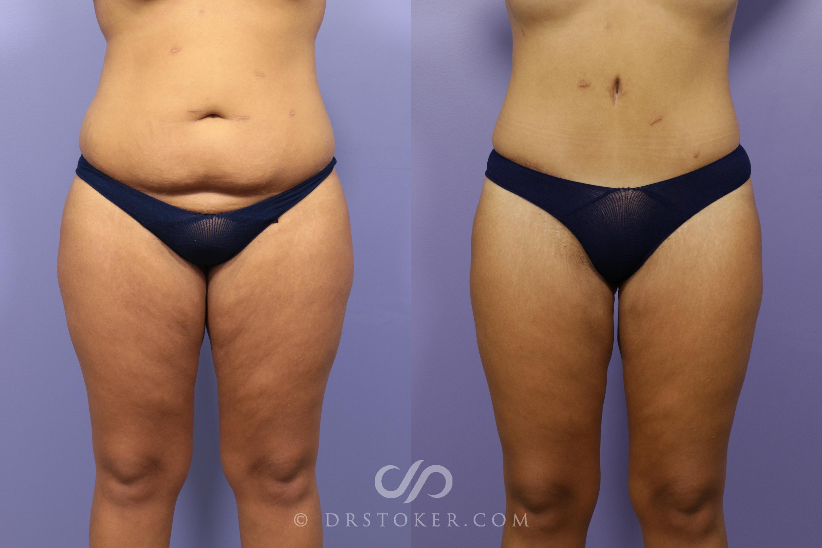 What's the Difference Between Liposuction and Tummy Tuck (& Which Is Best  for You)?