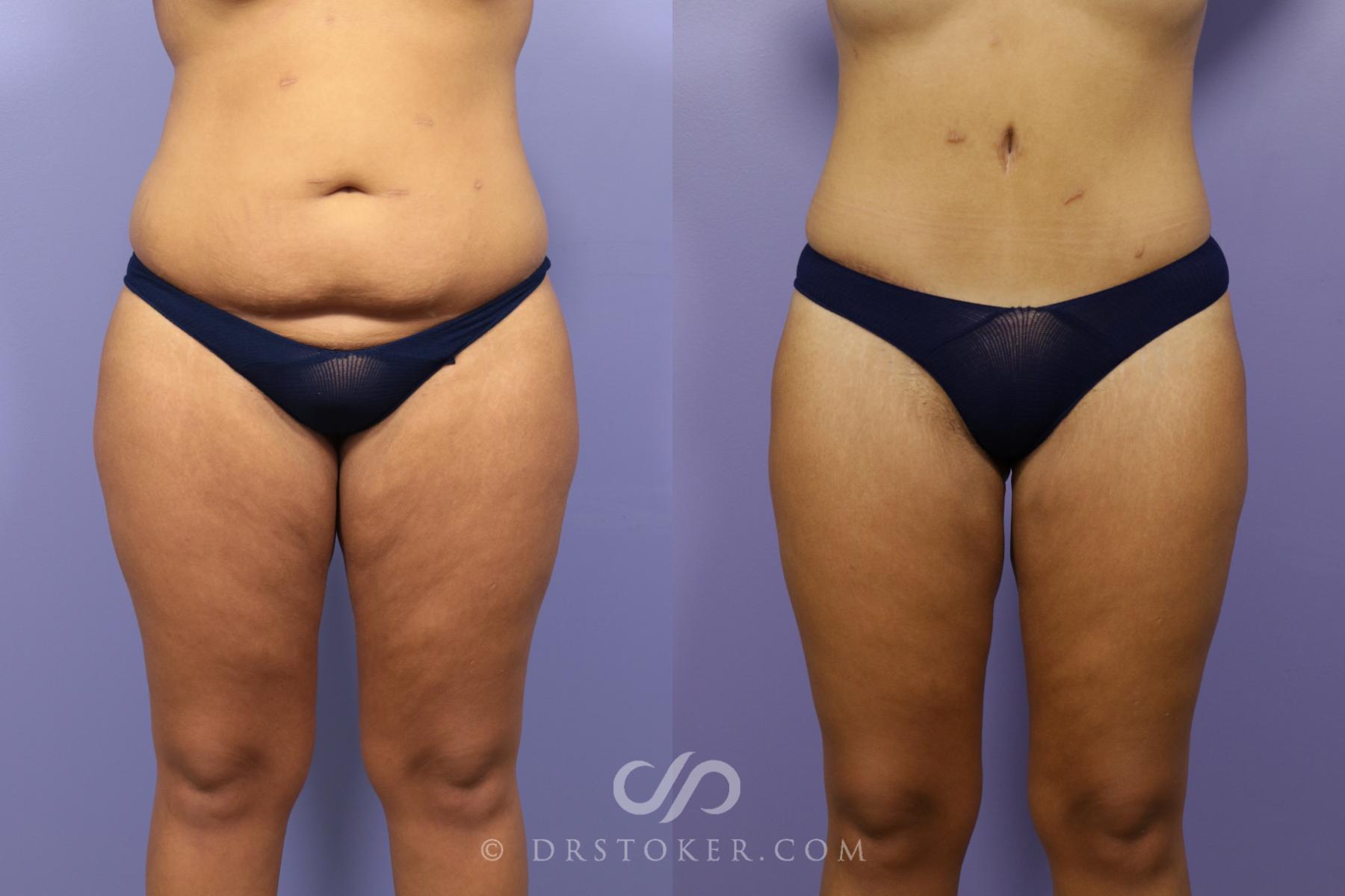 Before & After Tummy Tuck Case 1486 View #1 View in Los Angeles, CA