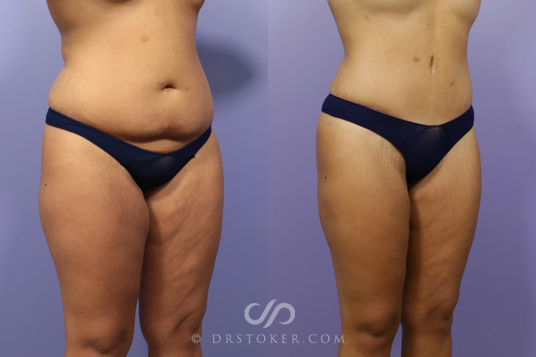 Before & After Tummy Tuck Case 1486 View #2 View in Los Angeles, CA