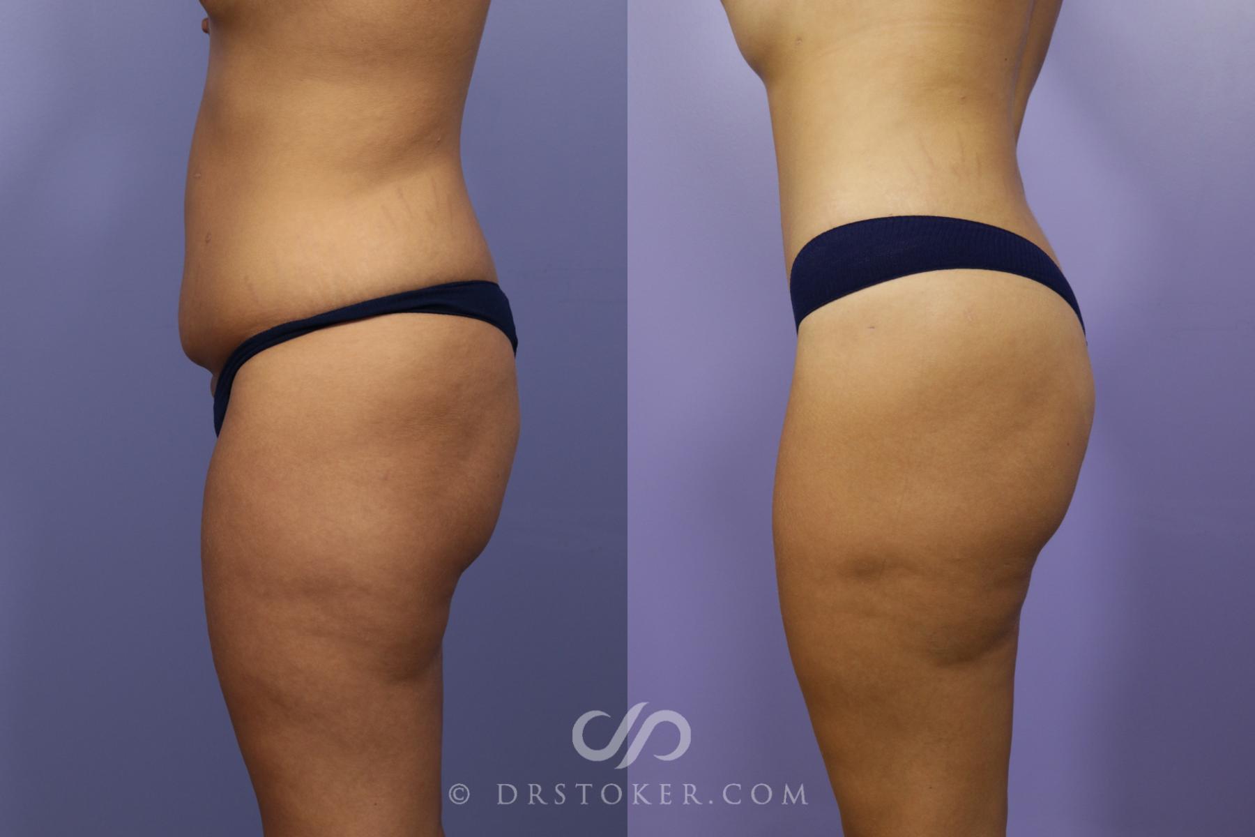 Before & After Tummy Tuck Case 1486 View #3 View in Los Angeles, CA