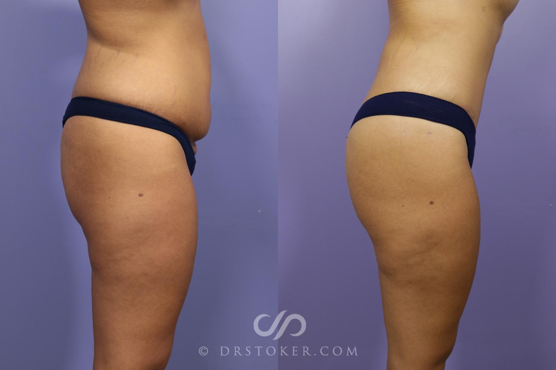 Before & After Tummy Tuck Case 1486 View #4 View in Los Angeles, CA