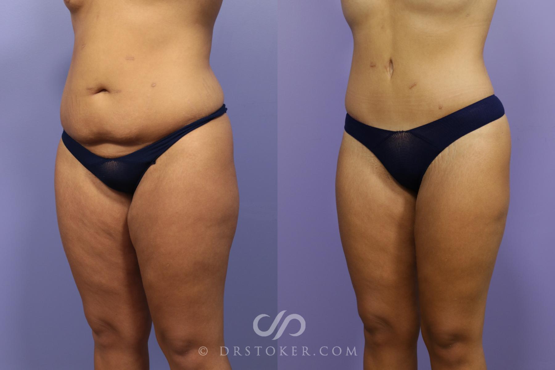 Before & After Tummy Tuck Case 1486 View #5 View in Los Angeles, CA