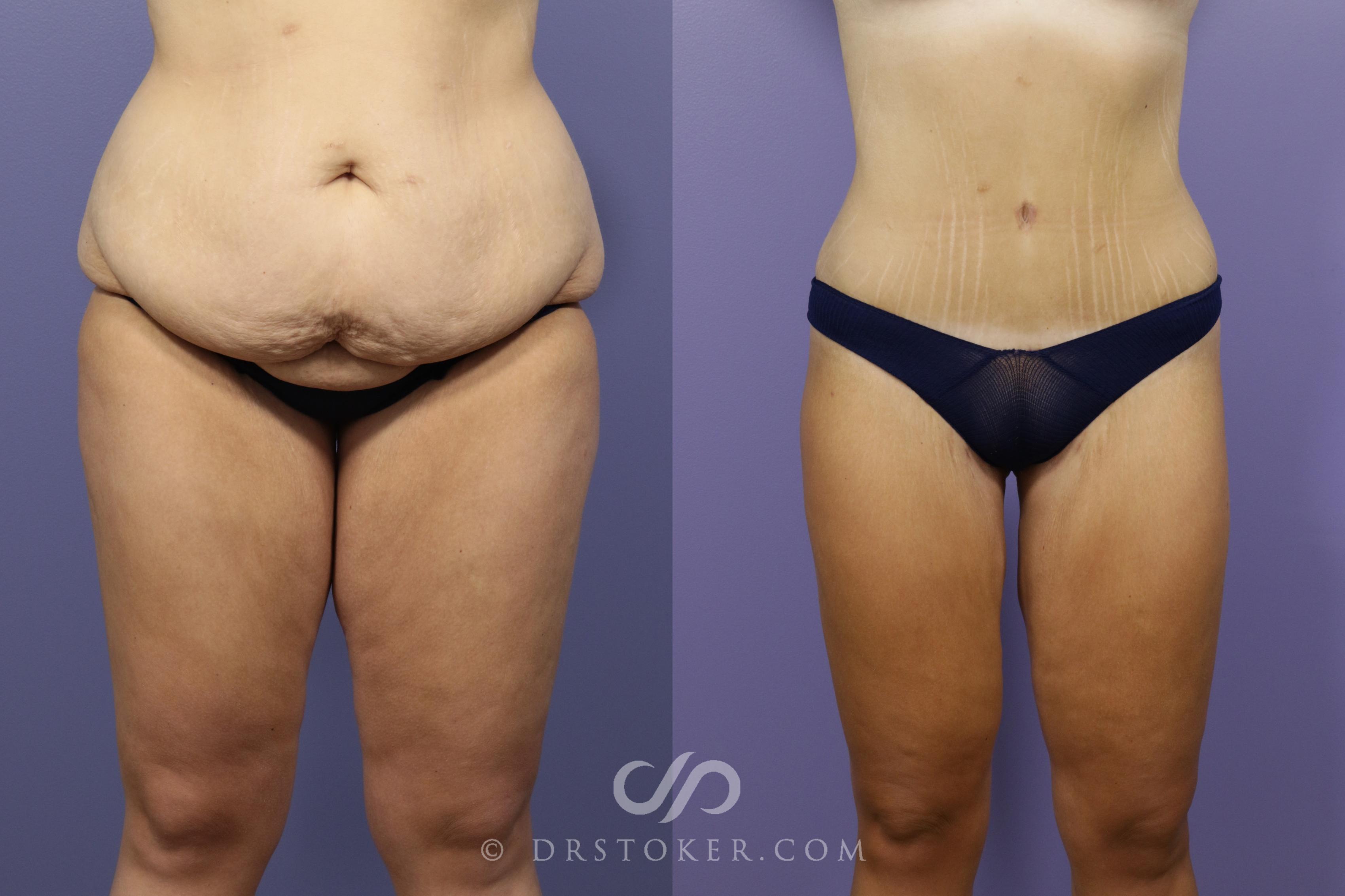 Before & After Tummy Tuck Case 1488 View #1 View in Los Angeles, CA