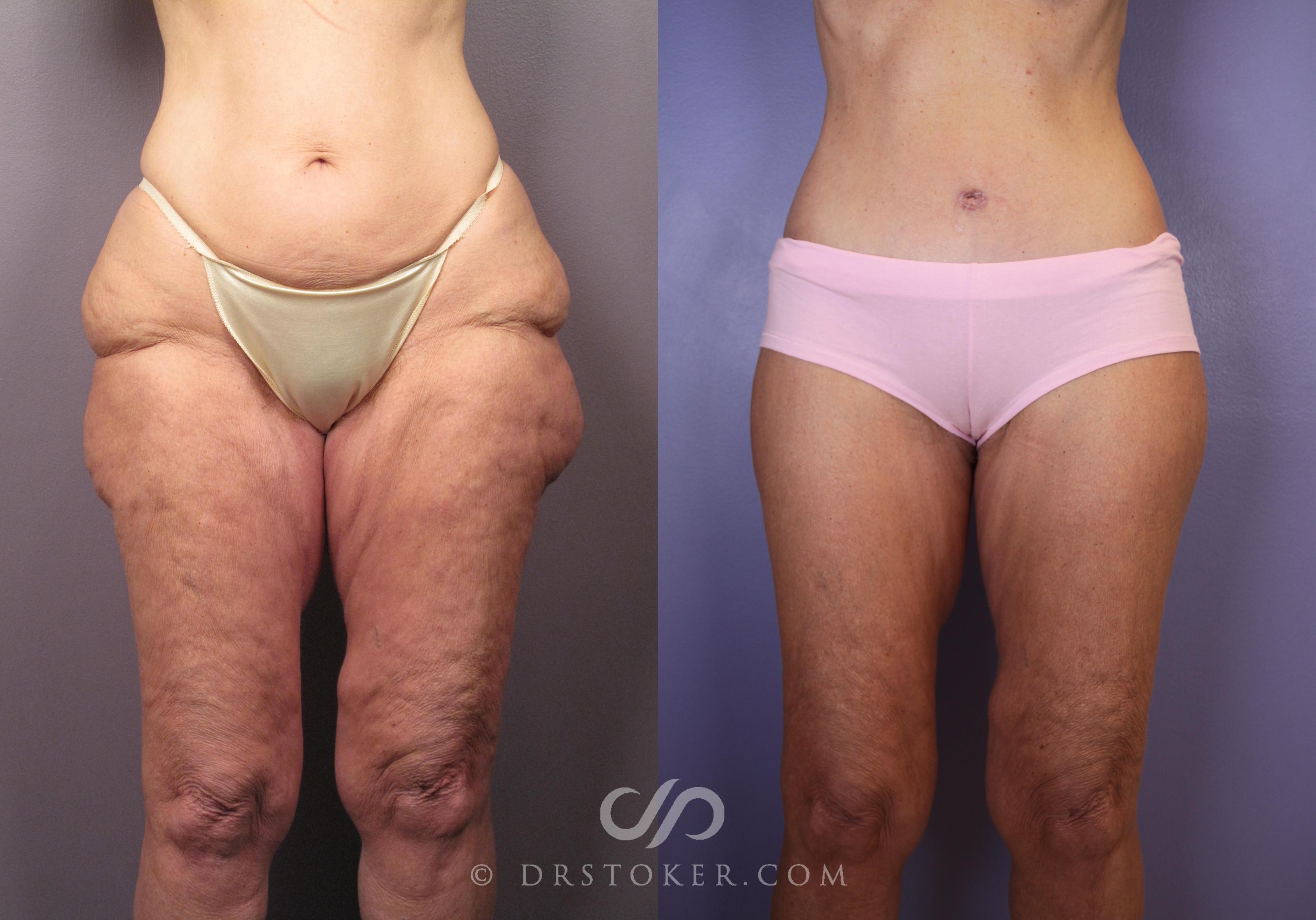 Before & After Tummy Tuck Case 1489 View #1 View in Los Angeles, CA