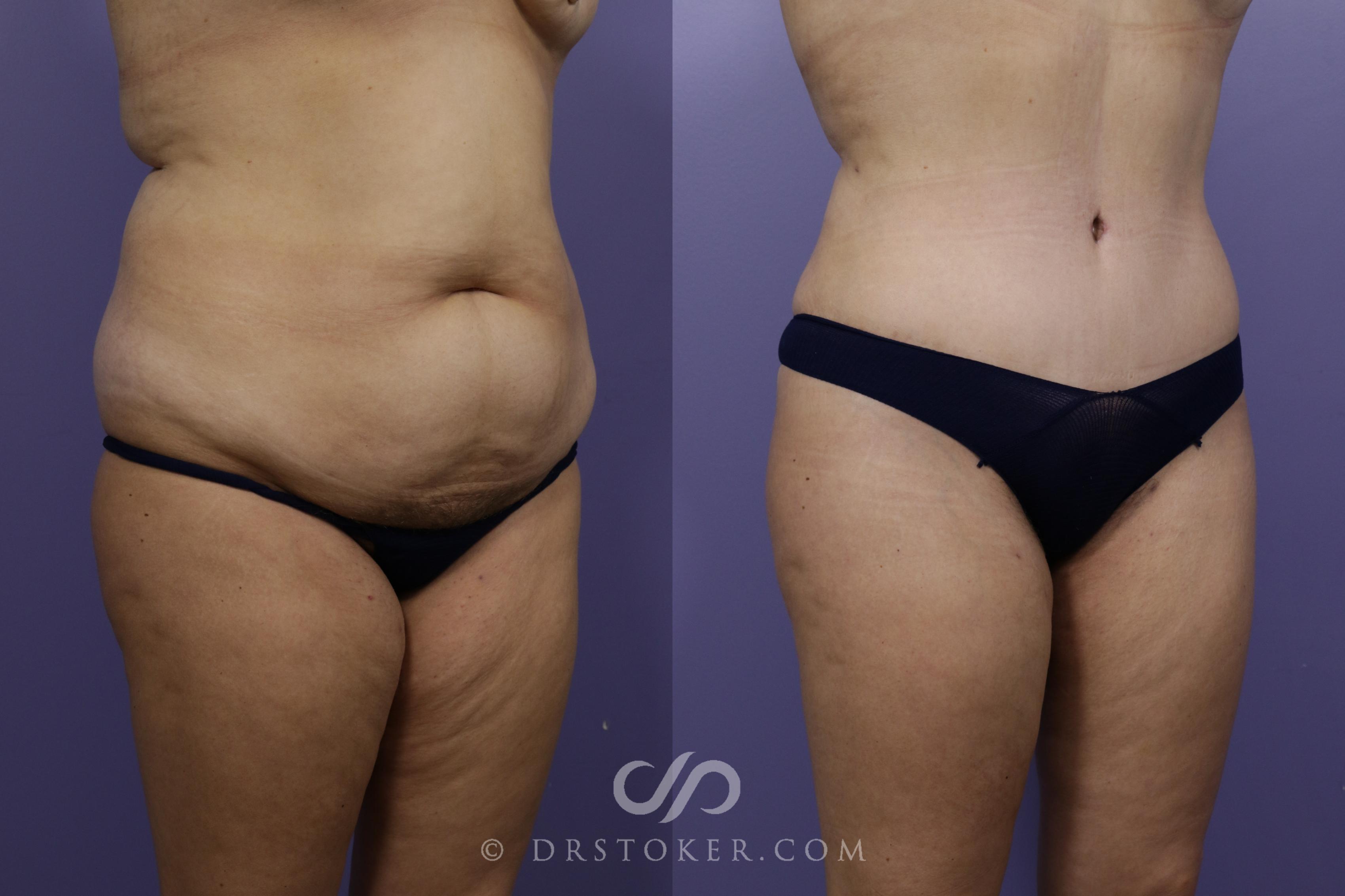 Before & After Tummy Tuck Case 1567 View #2 View in Los Angeles, CA